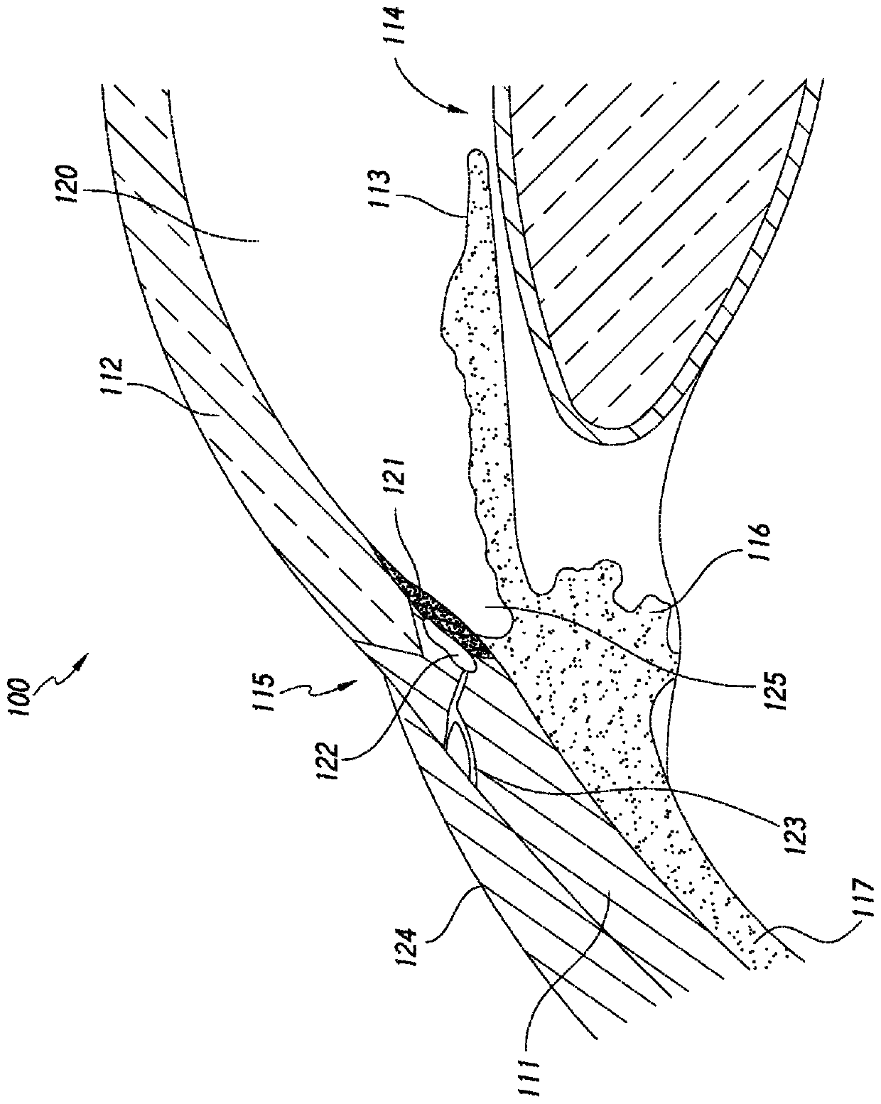 Systems and methods for delivering multiple ocular implants