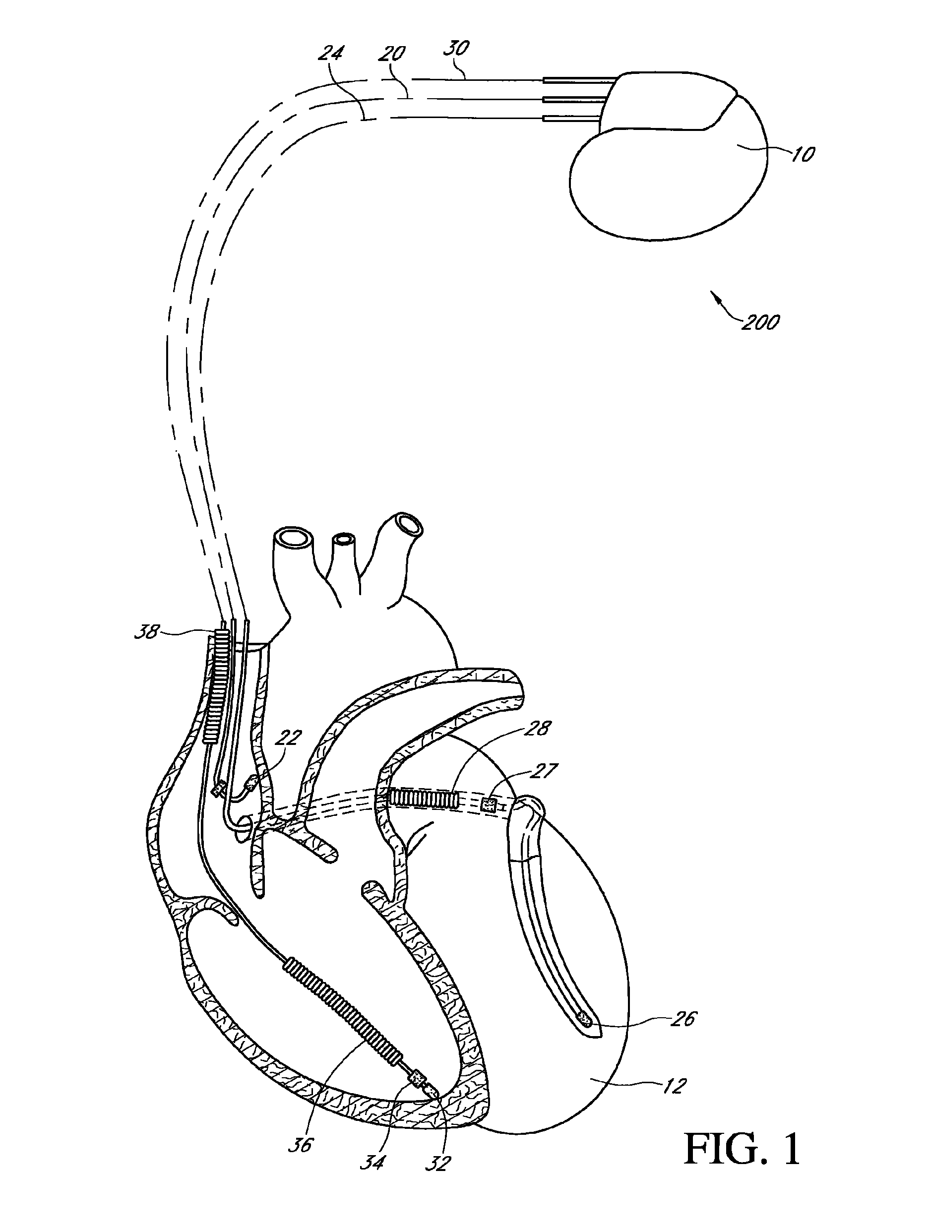 Implantable therapeutic device control system