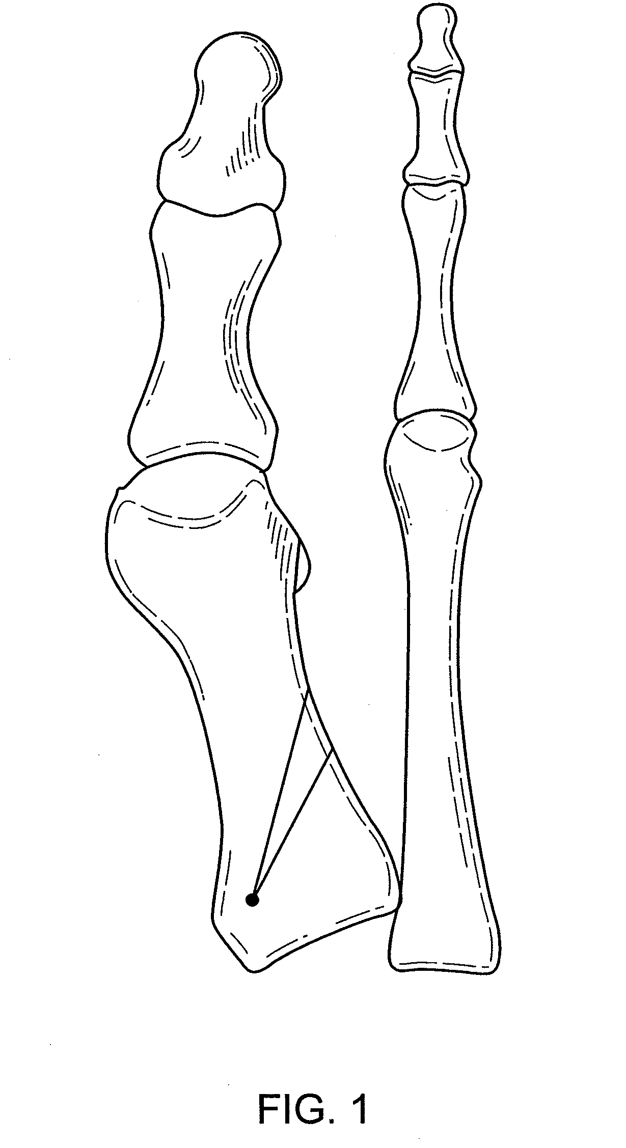 Osteotomy guide