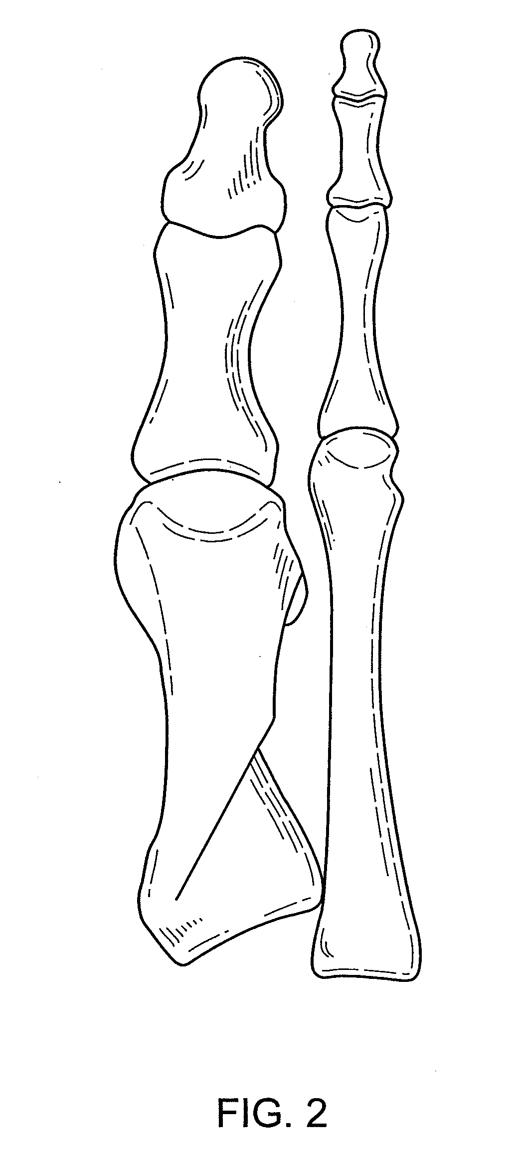 Osteotomy guide