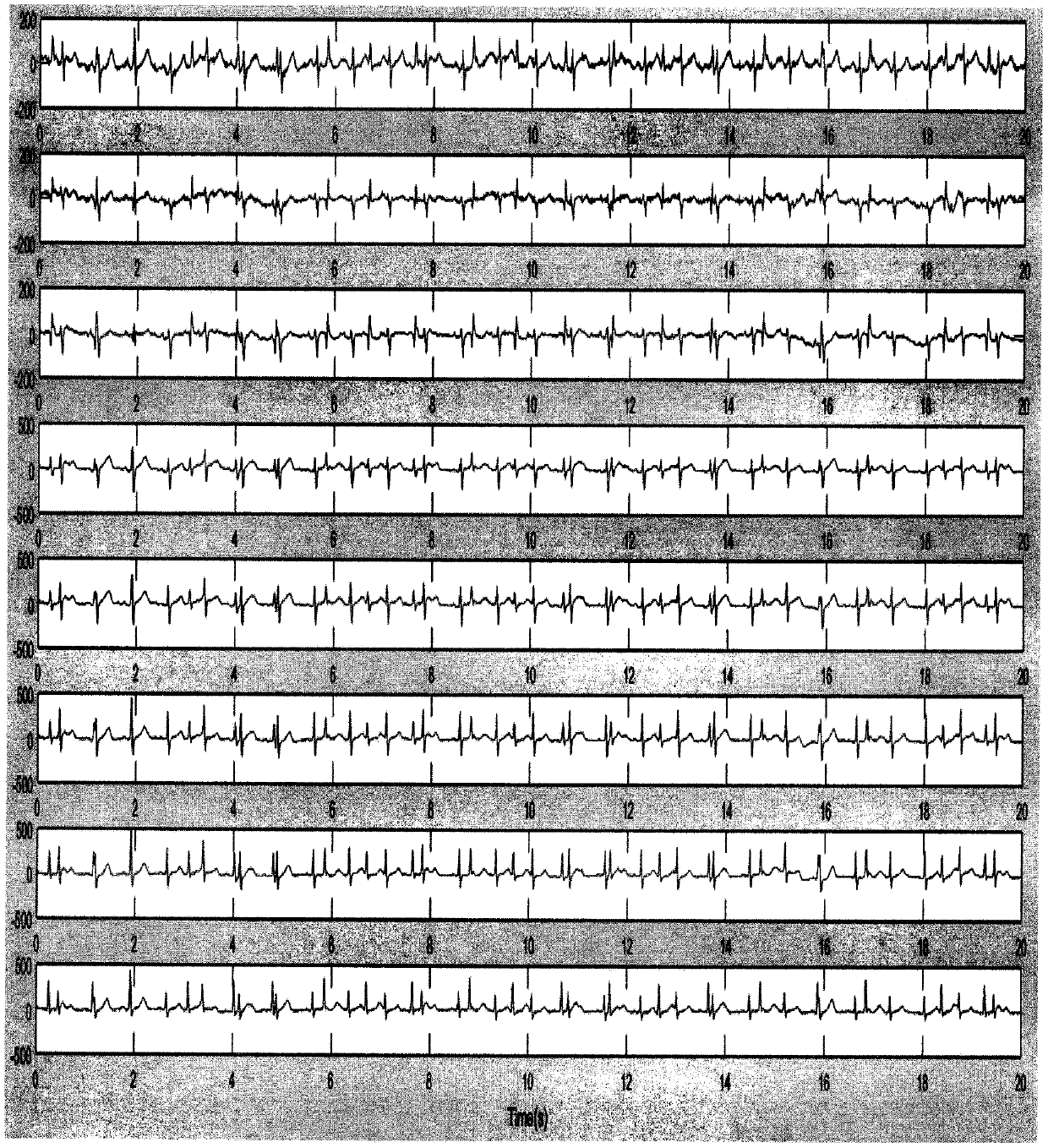 Method for enhancing synchronously recorded multichannel electrocardio signals