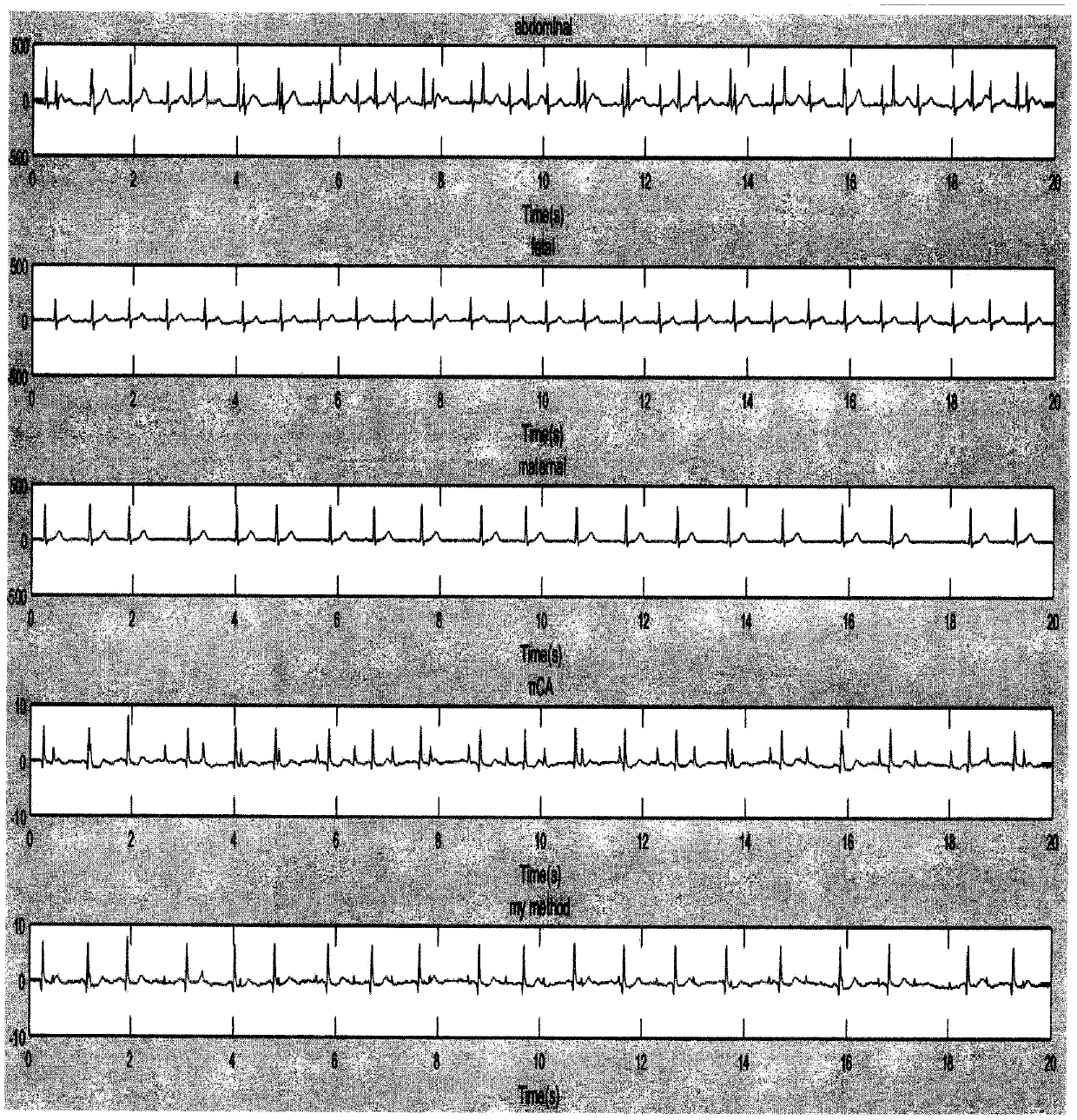 Method for enhancing synchronously recorded multichannel electrocardio signals