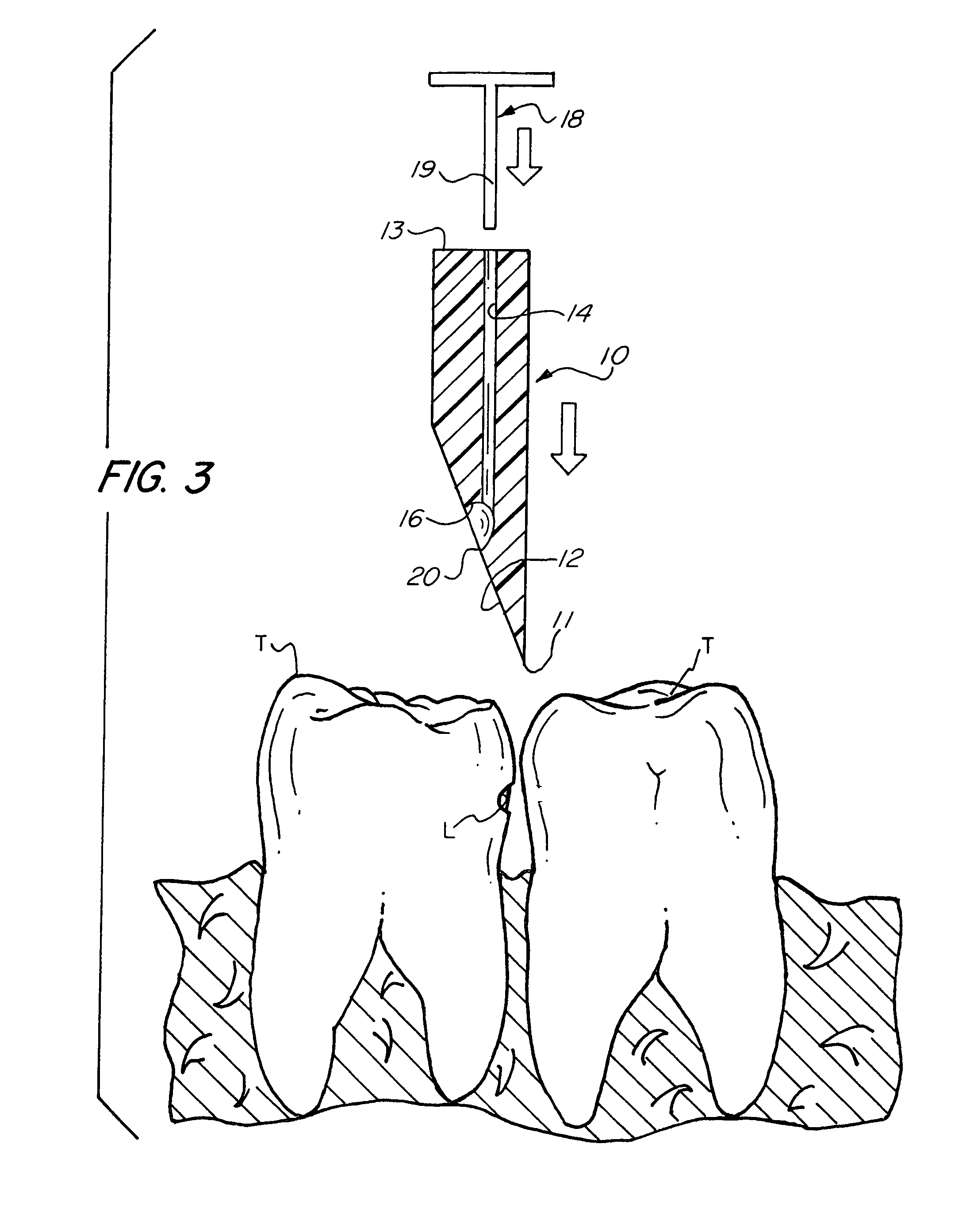 Interproximal non-surgical caries treatment device and method