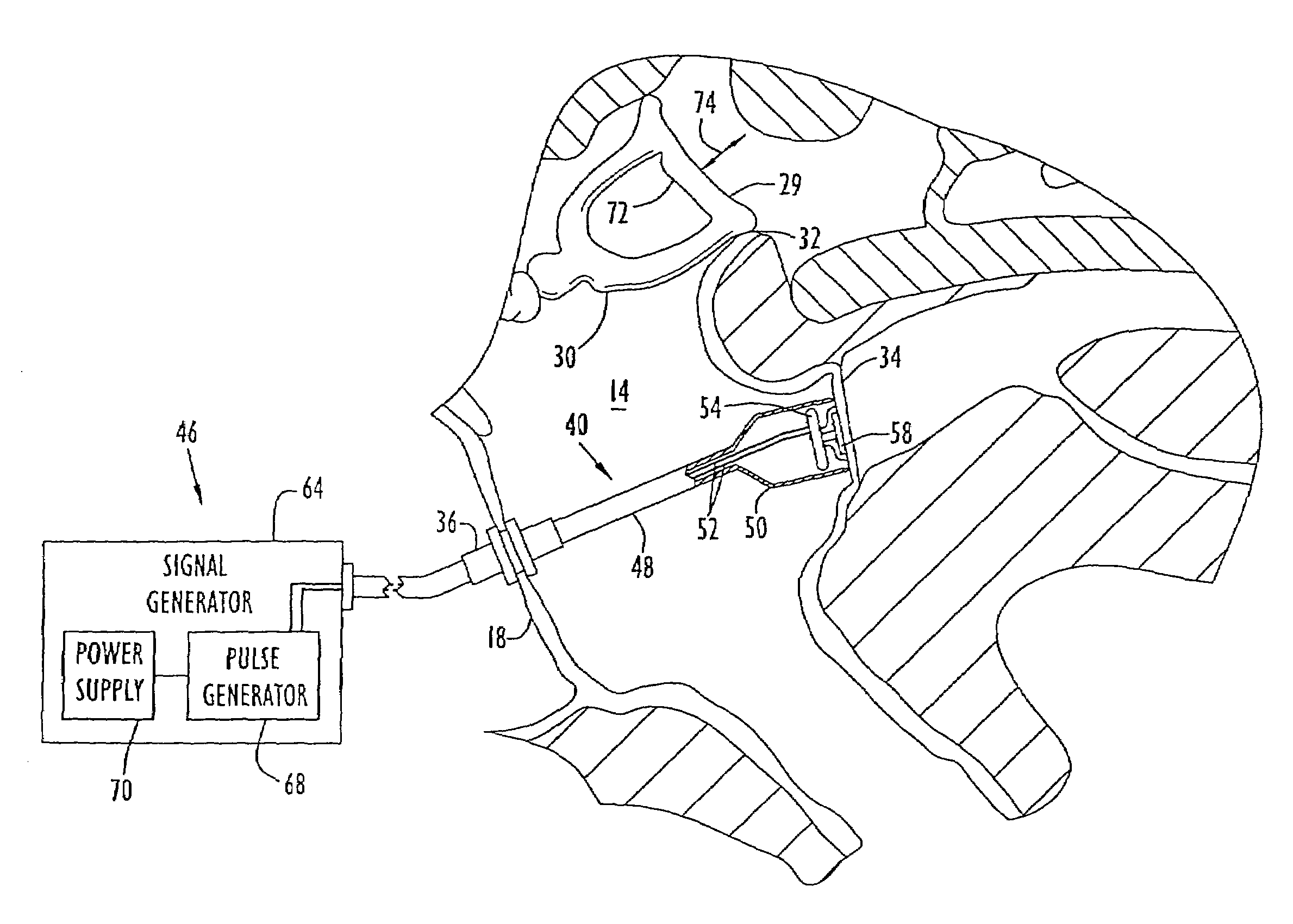 Apparatus and methods for directly displacing the partition between the middle ear and inner ear at an infrasonic frequency