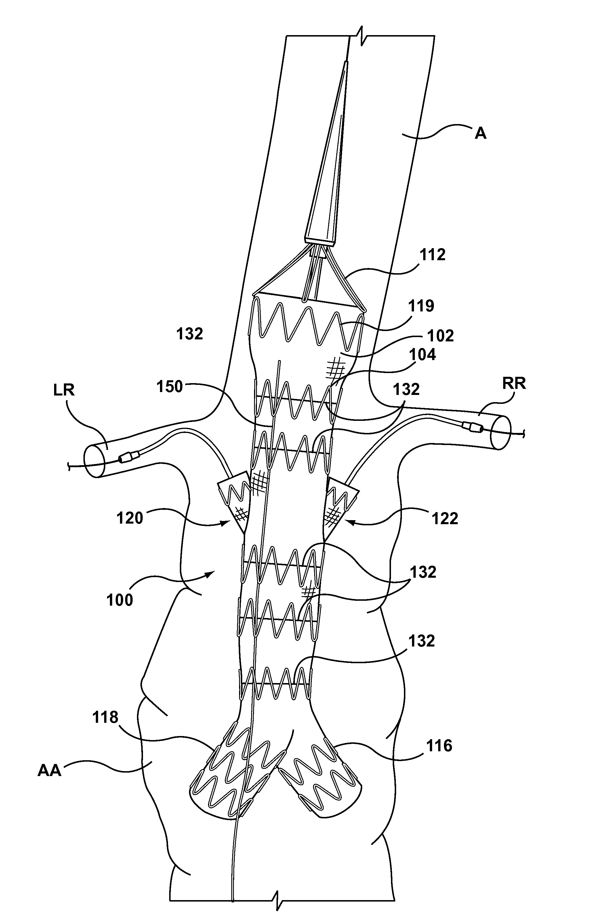 Circumferentially constraining sutures for a stent-graft