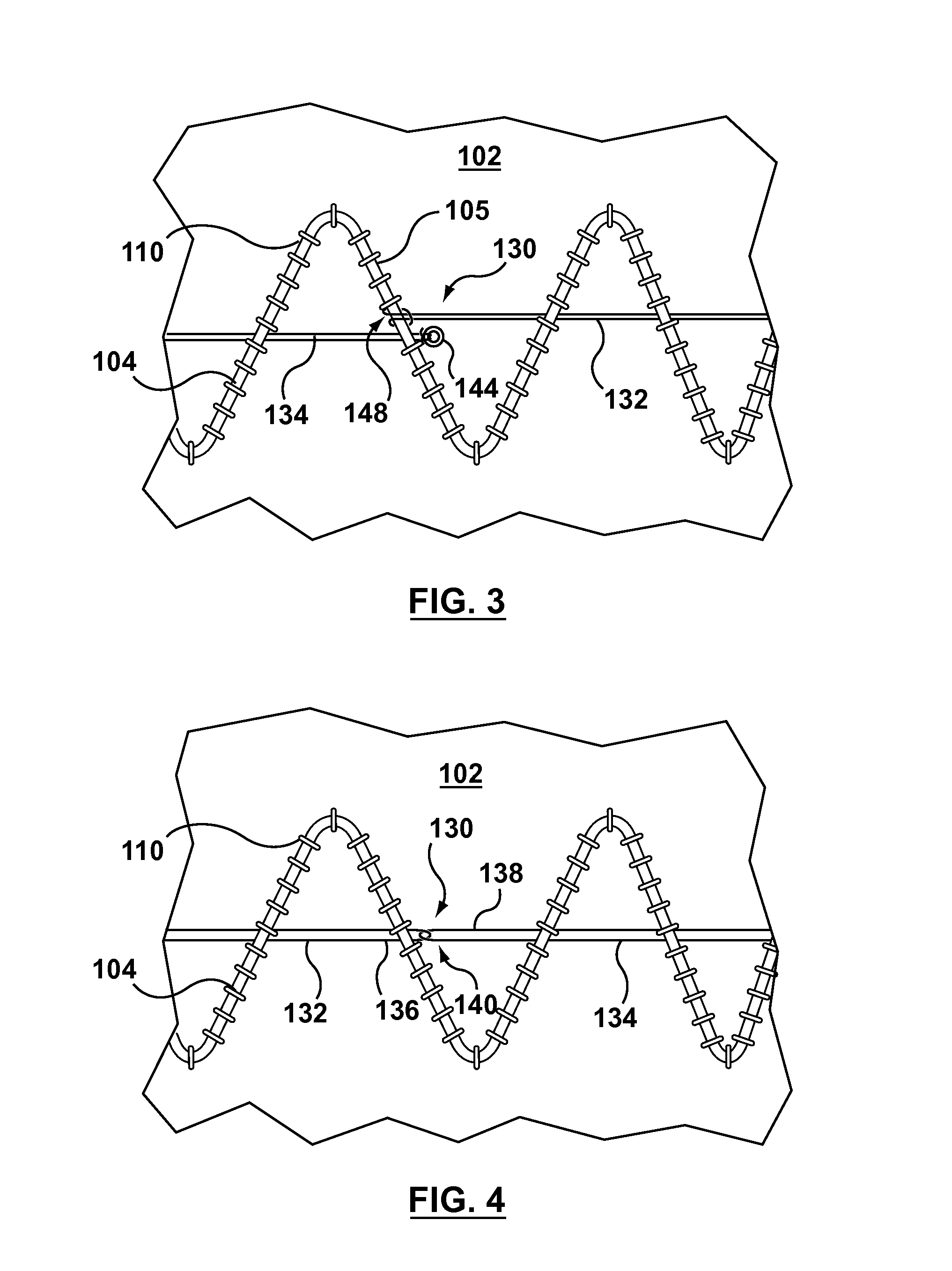 Circumferentially constraining sutures for a stent-graft