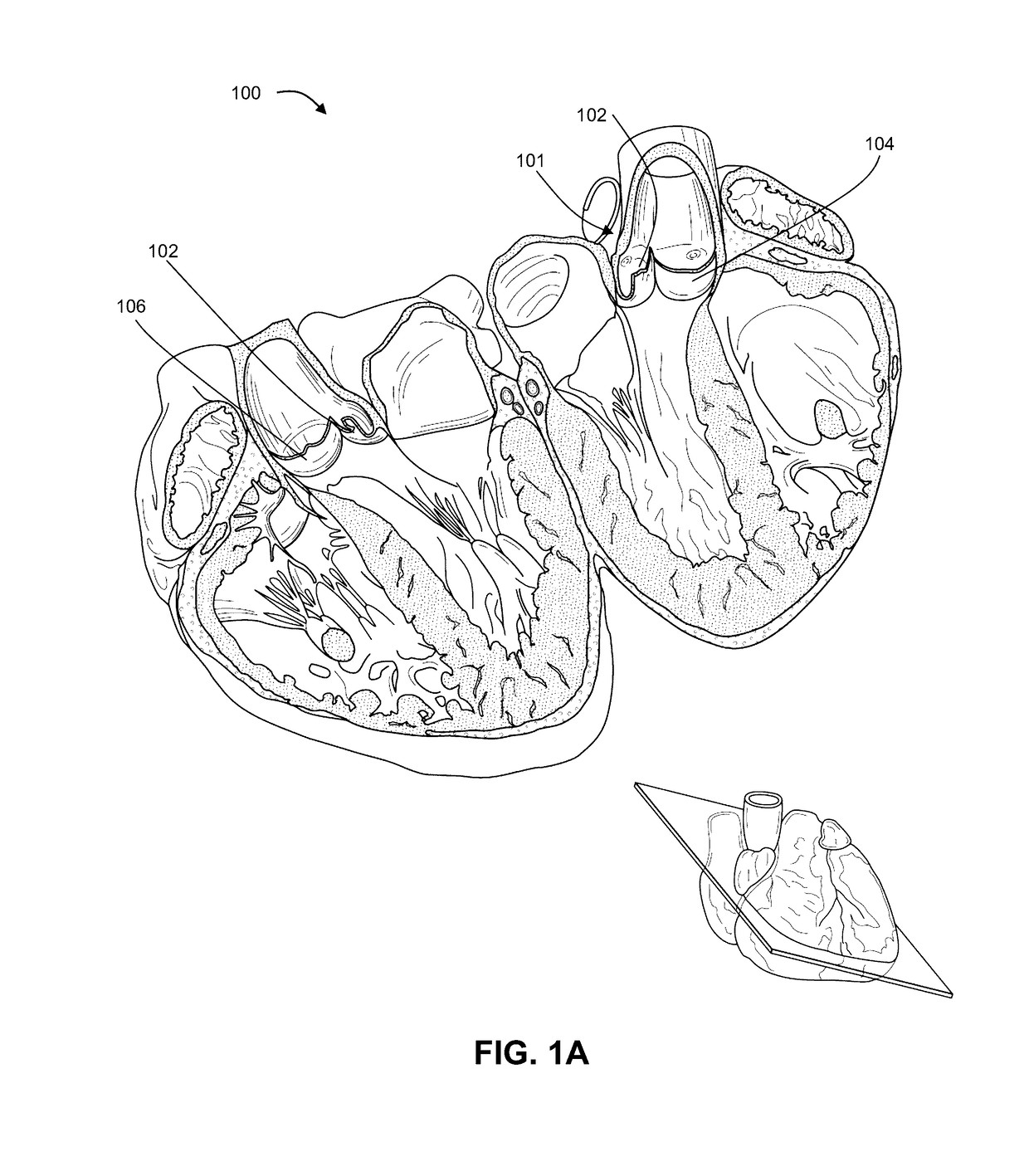 Shock wave valvuloplasty with multiple balloons