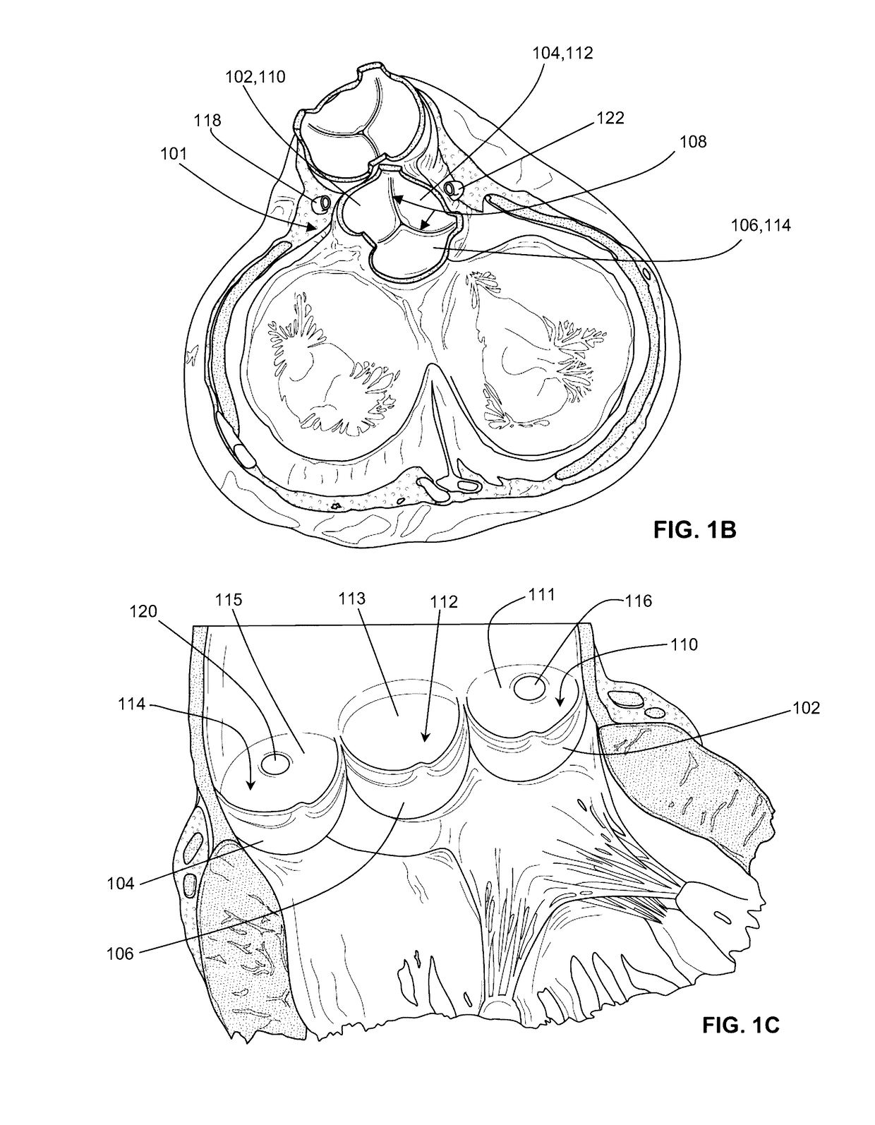 Shock wave valvuloplasty with multiple balloons