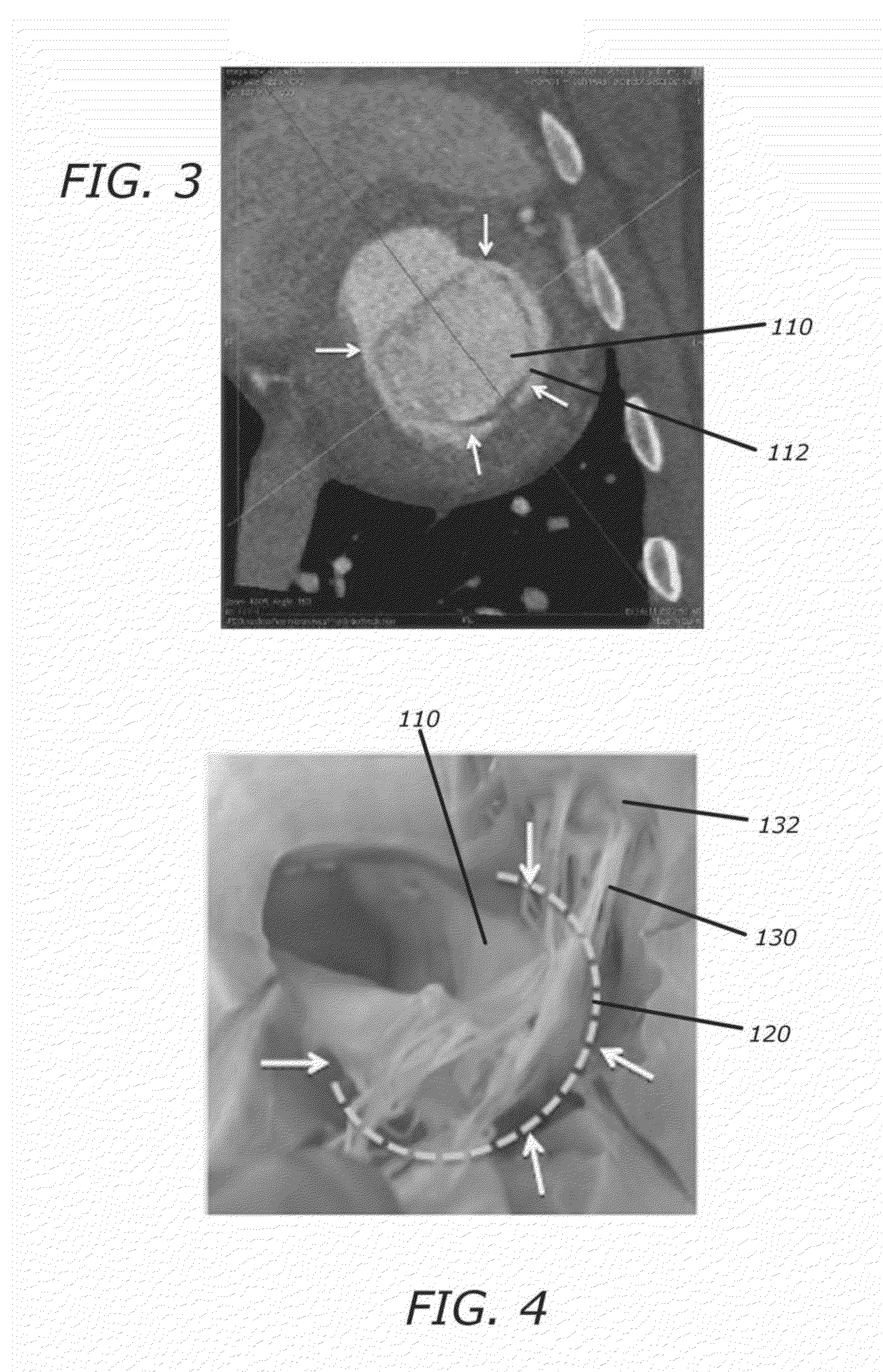 Methods and systems for heart valve therapy