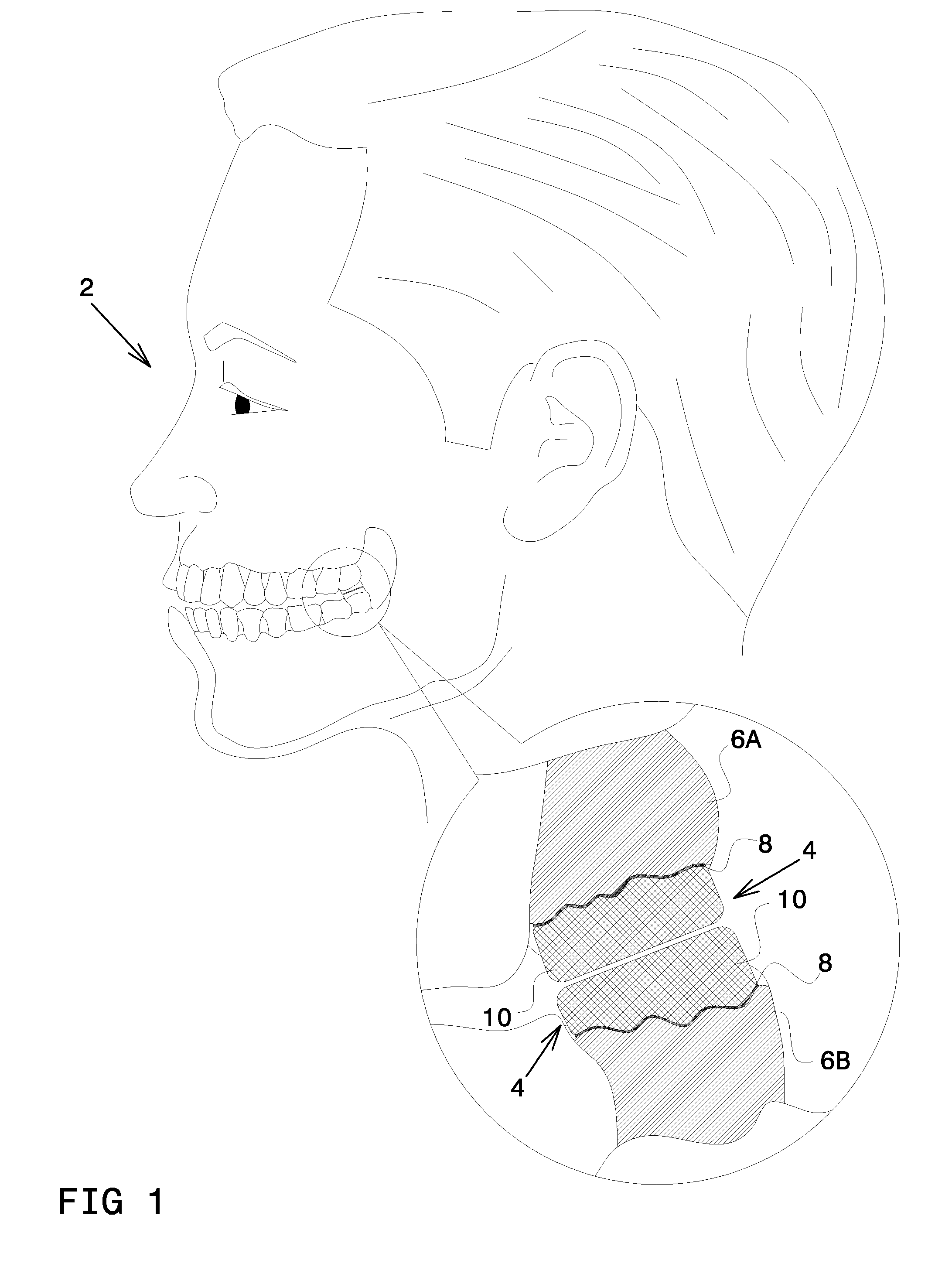 Apparatus for Chewing Obstruction