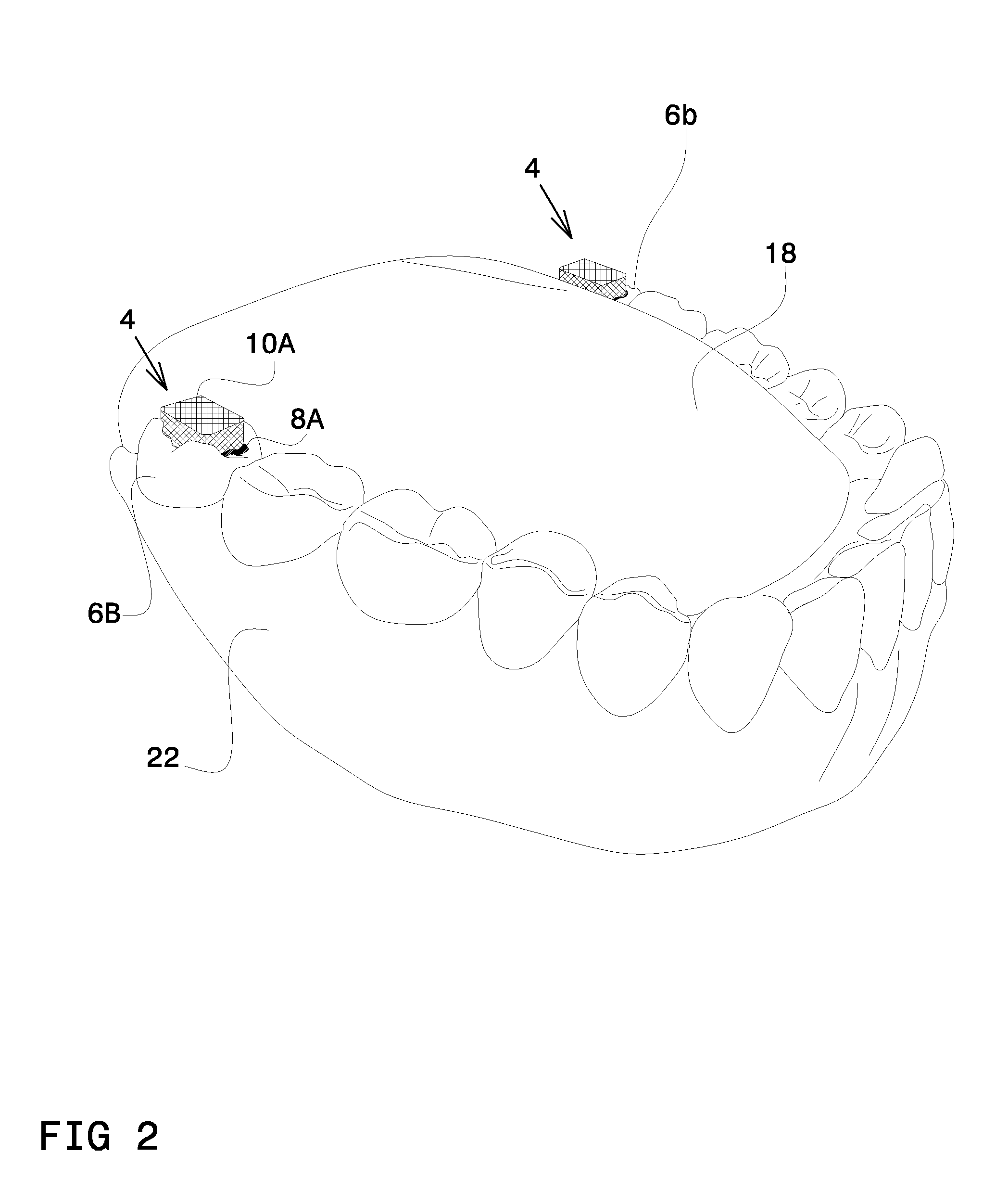 Apparatus for Chewing Obstruction