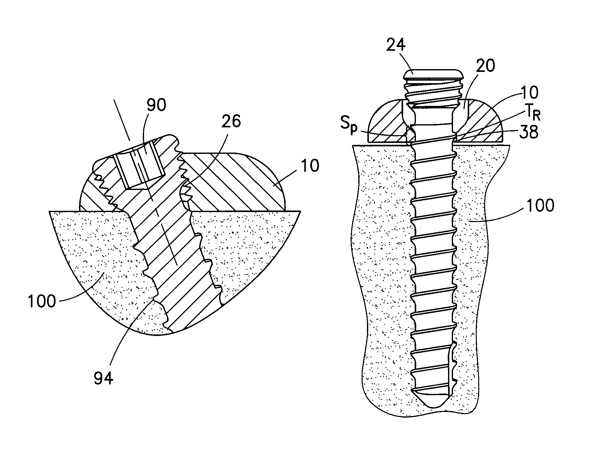 Reduced component bone plating system