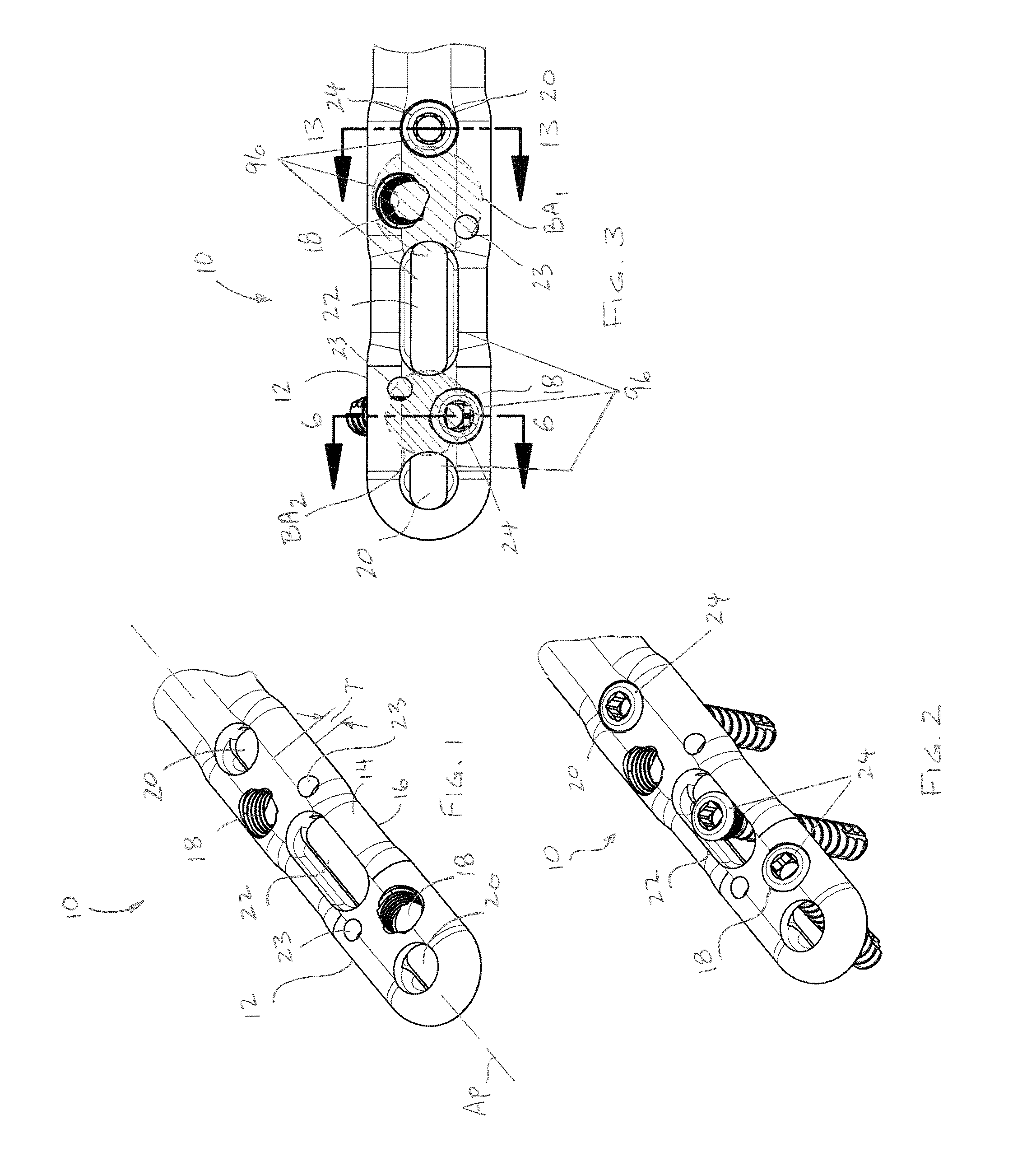 Reduced component bone plating system