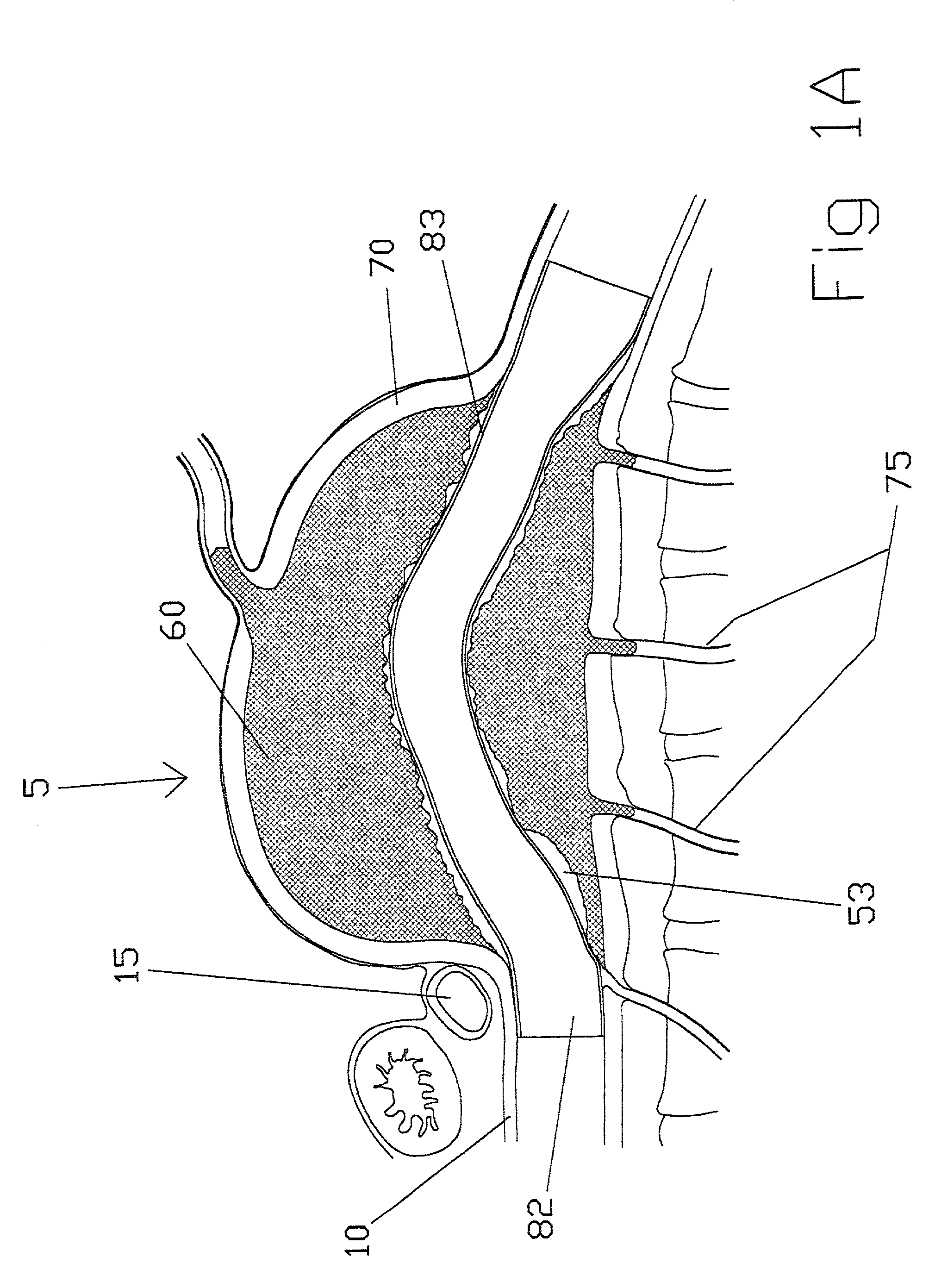 Intravascular folded tubular endoprosthesis