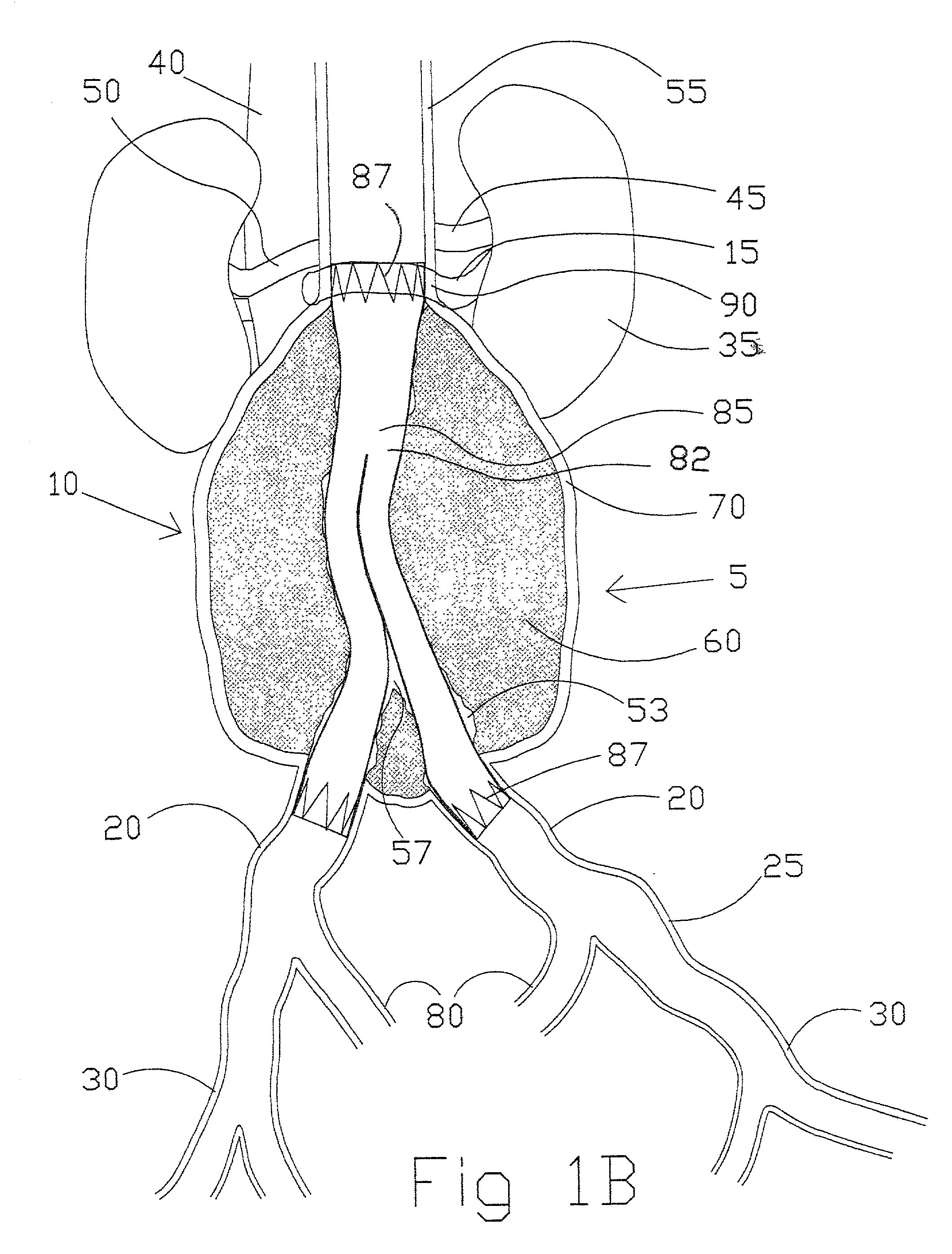 Intravascular folded tubular endoprosthesis