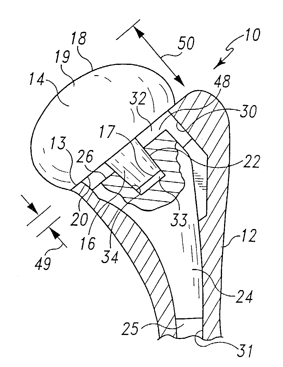 Collarless shoulder arthroplasty prosthesis