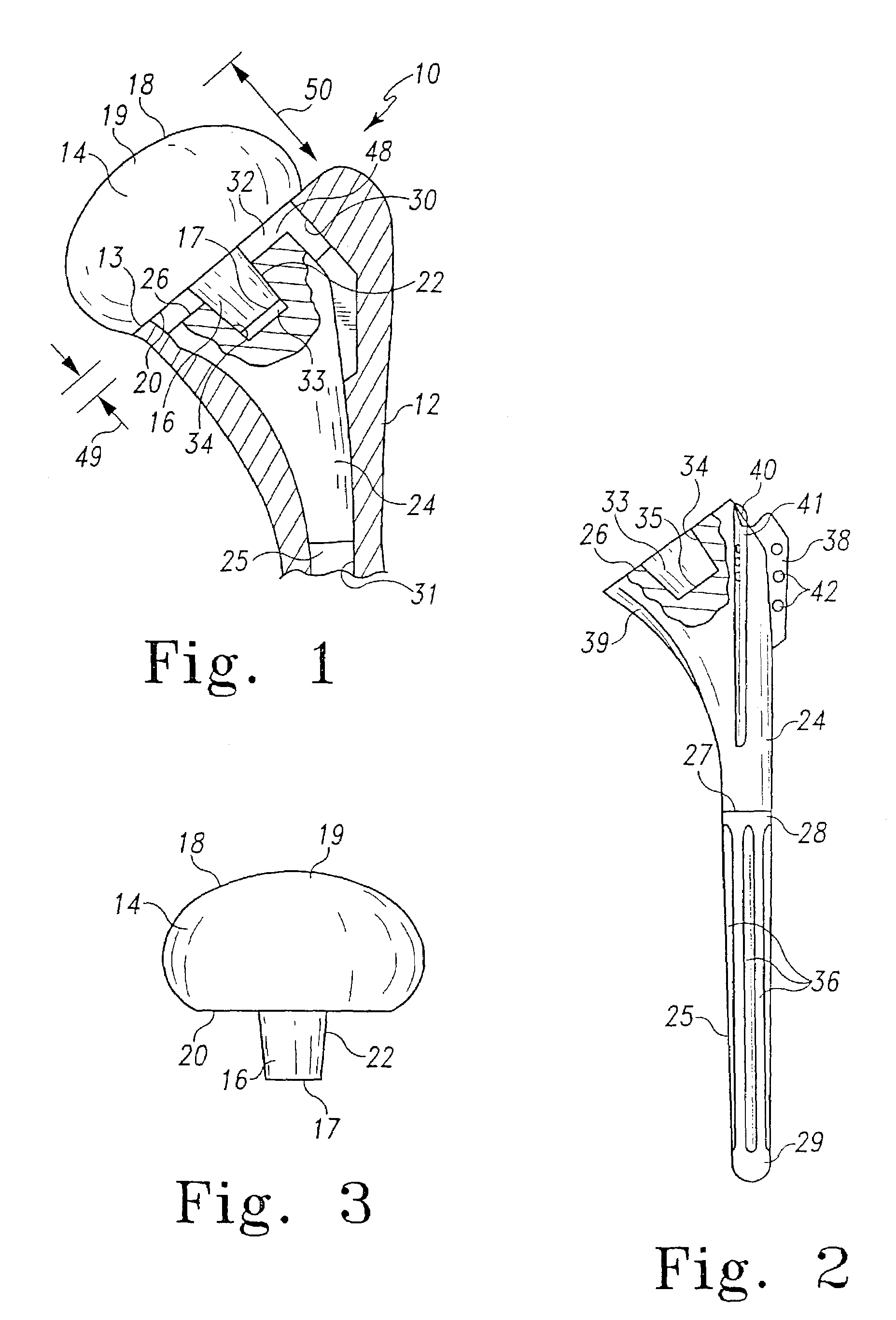 Collarless shoulder arthroplasty prosthesis