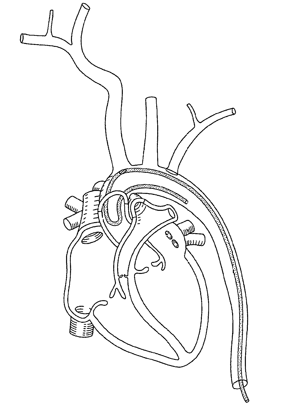 Vessel access catheter