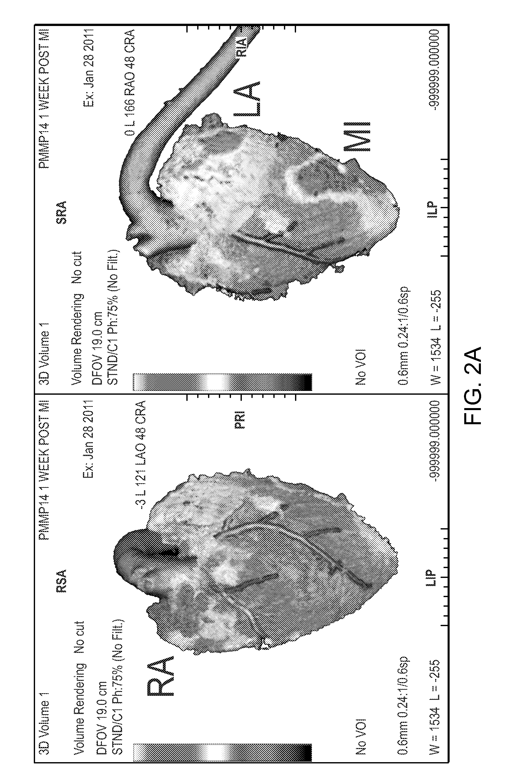 Evaluation of presence of and vulnerability to atrial fibrillation and other indications using matrix metalloproteinase-based imaging