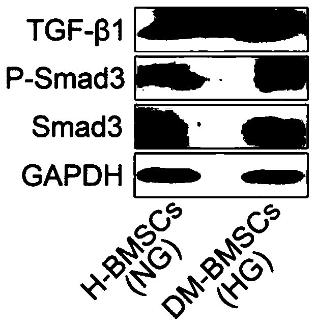 Application of TGF-beta 1 inhibitor in preparation of drugs to treat diabetic bone healing disorder