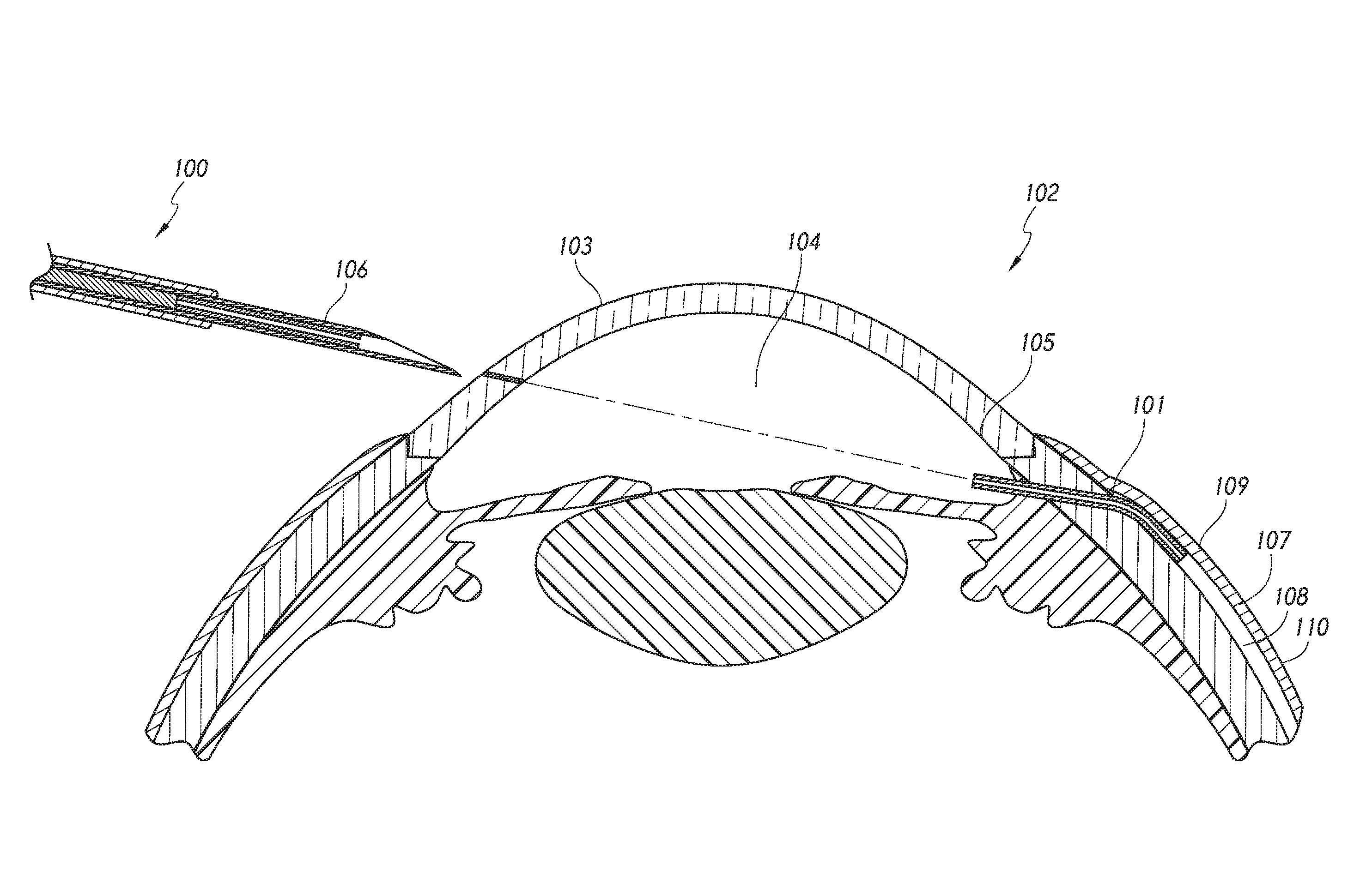 Intraocular shunt placement in the suprachoroidal space