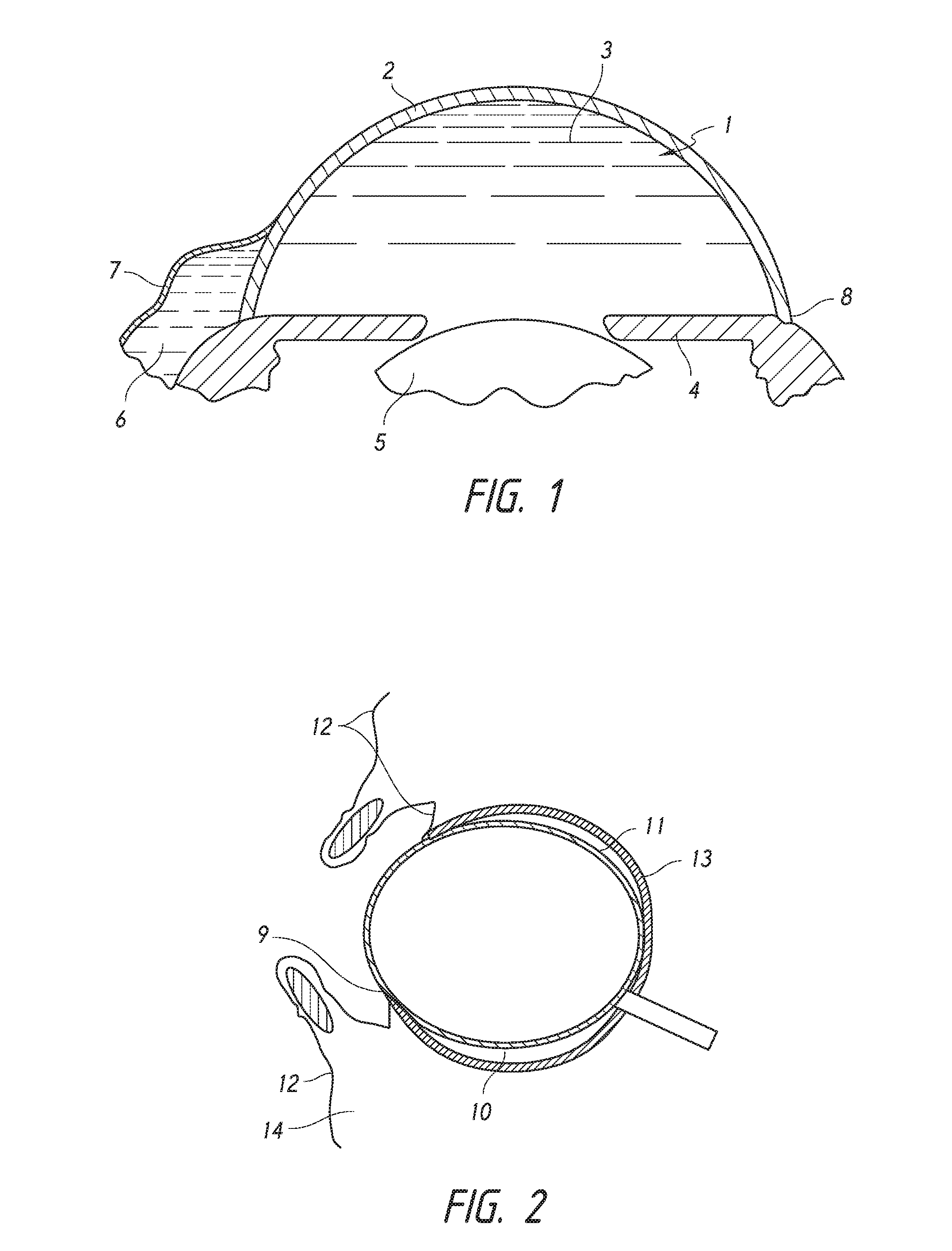 Intraocular shunt placement in the suprachoroidal space