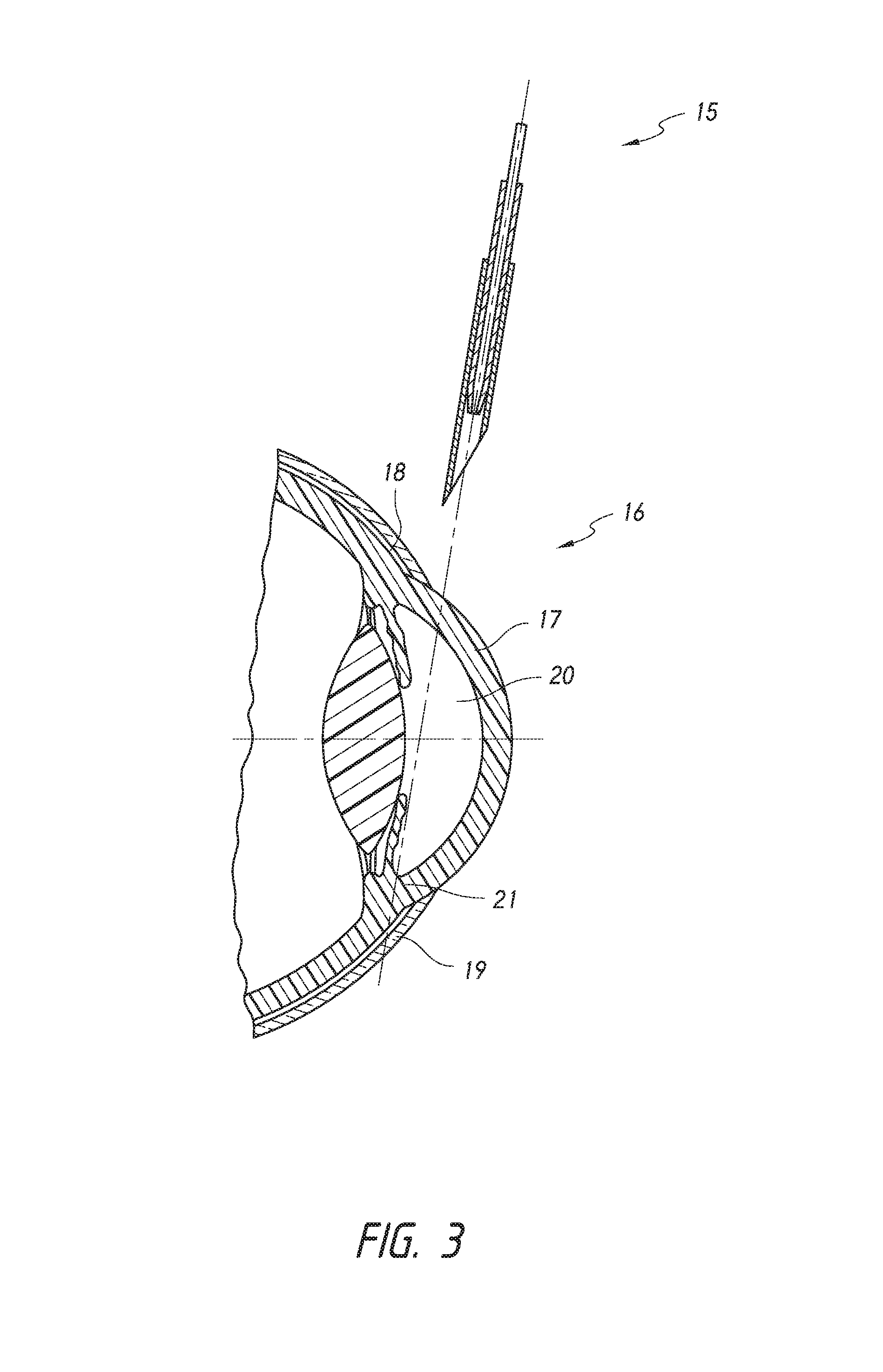 Intraocular shunt placement in the suprachoroidal space