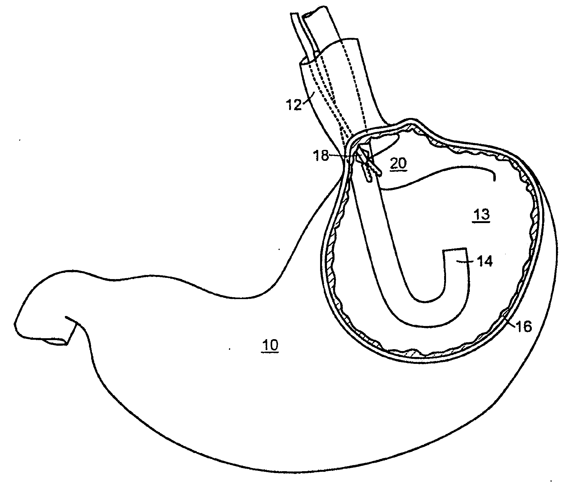 Methods and Devices for Tissue Reconfiguration