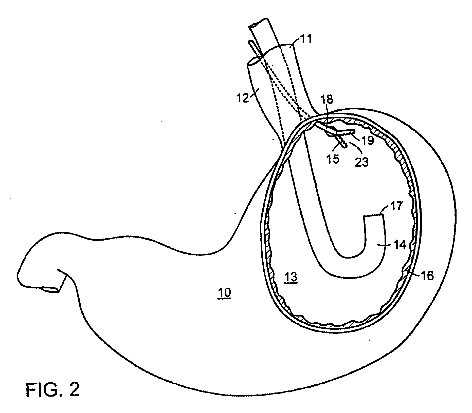 Methods and Devices for Tissue Reconfiguration