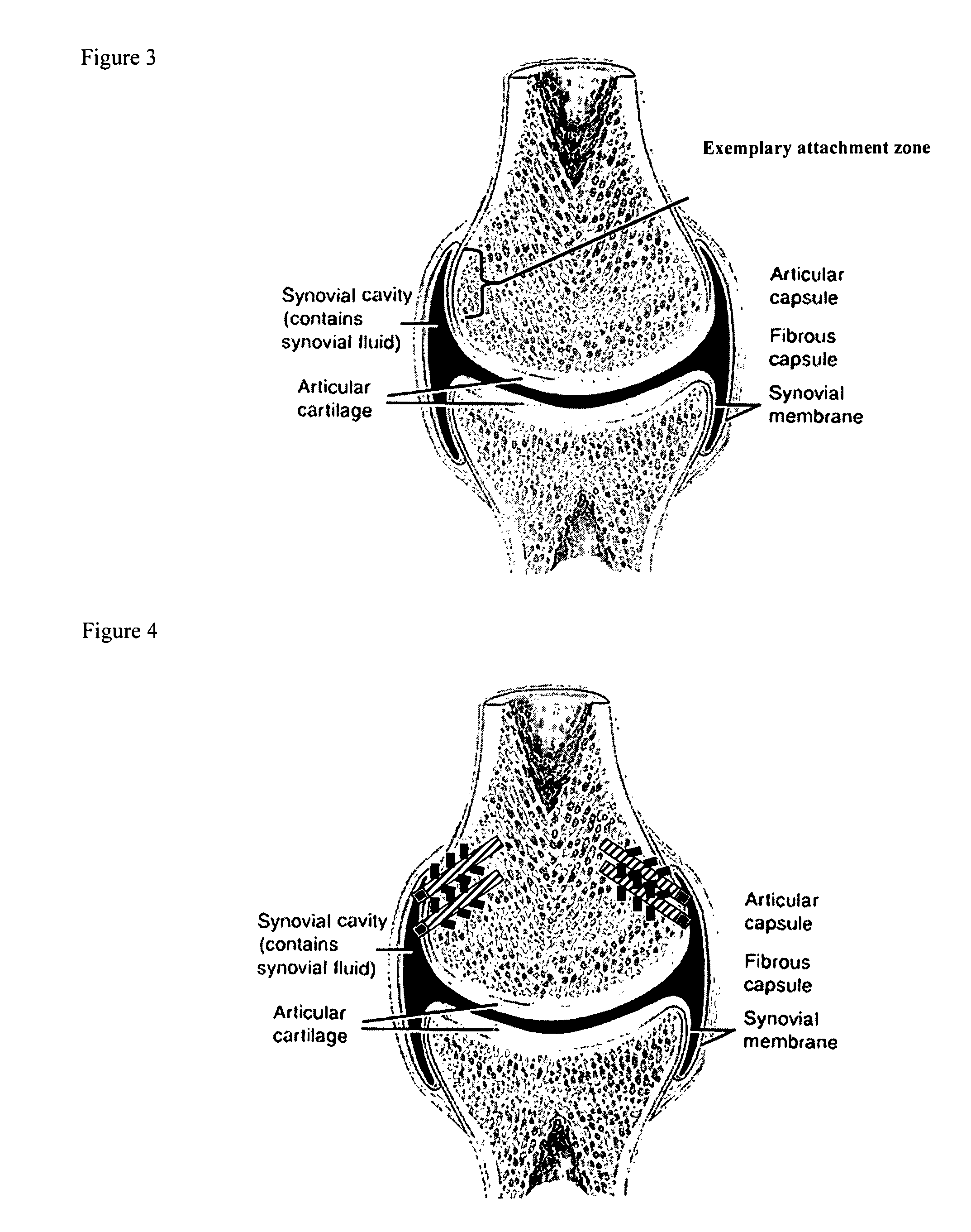 Drug delivery to a joint