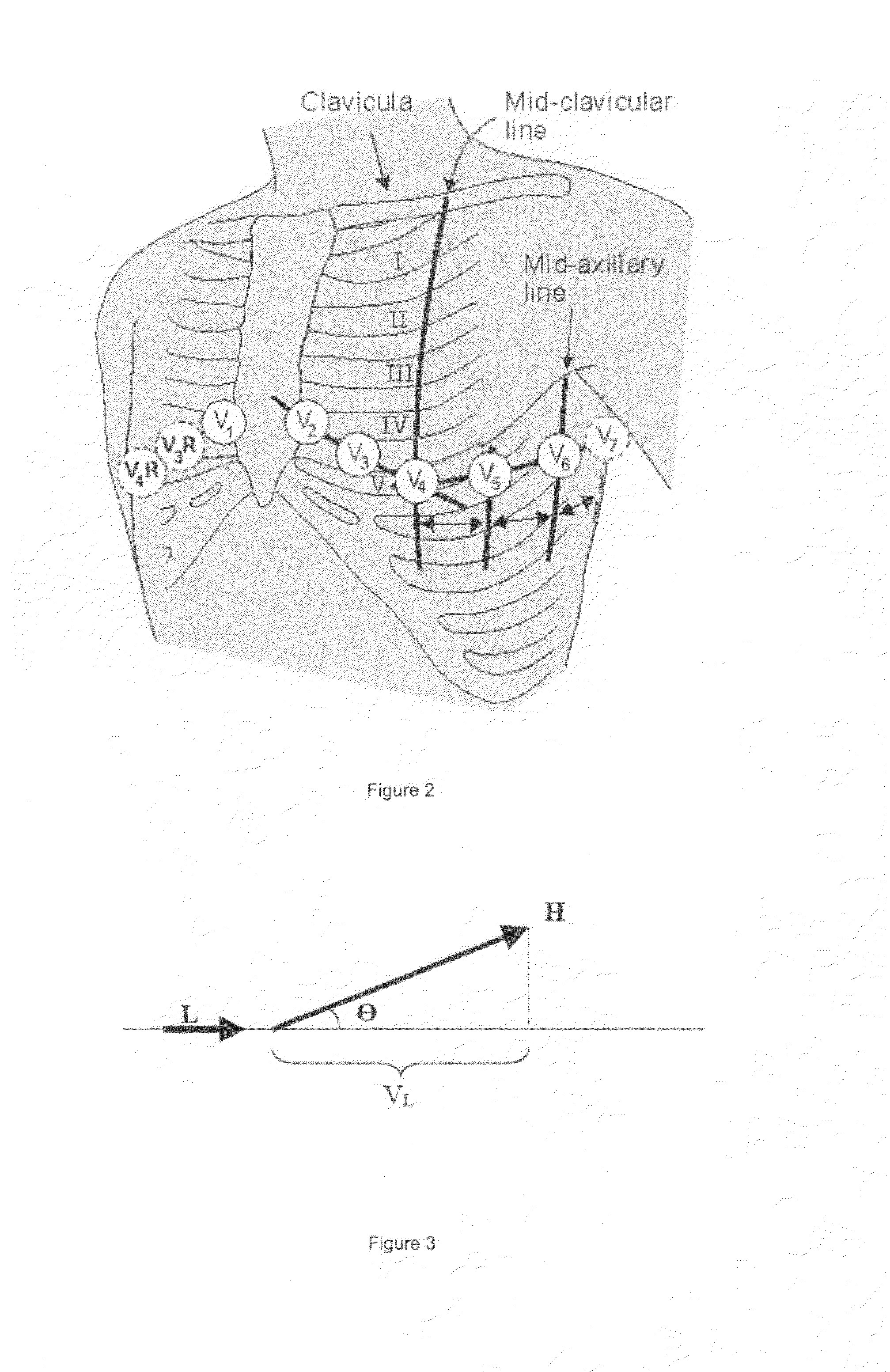 System, method and apparatus for detecting a cardiac event