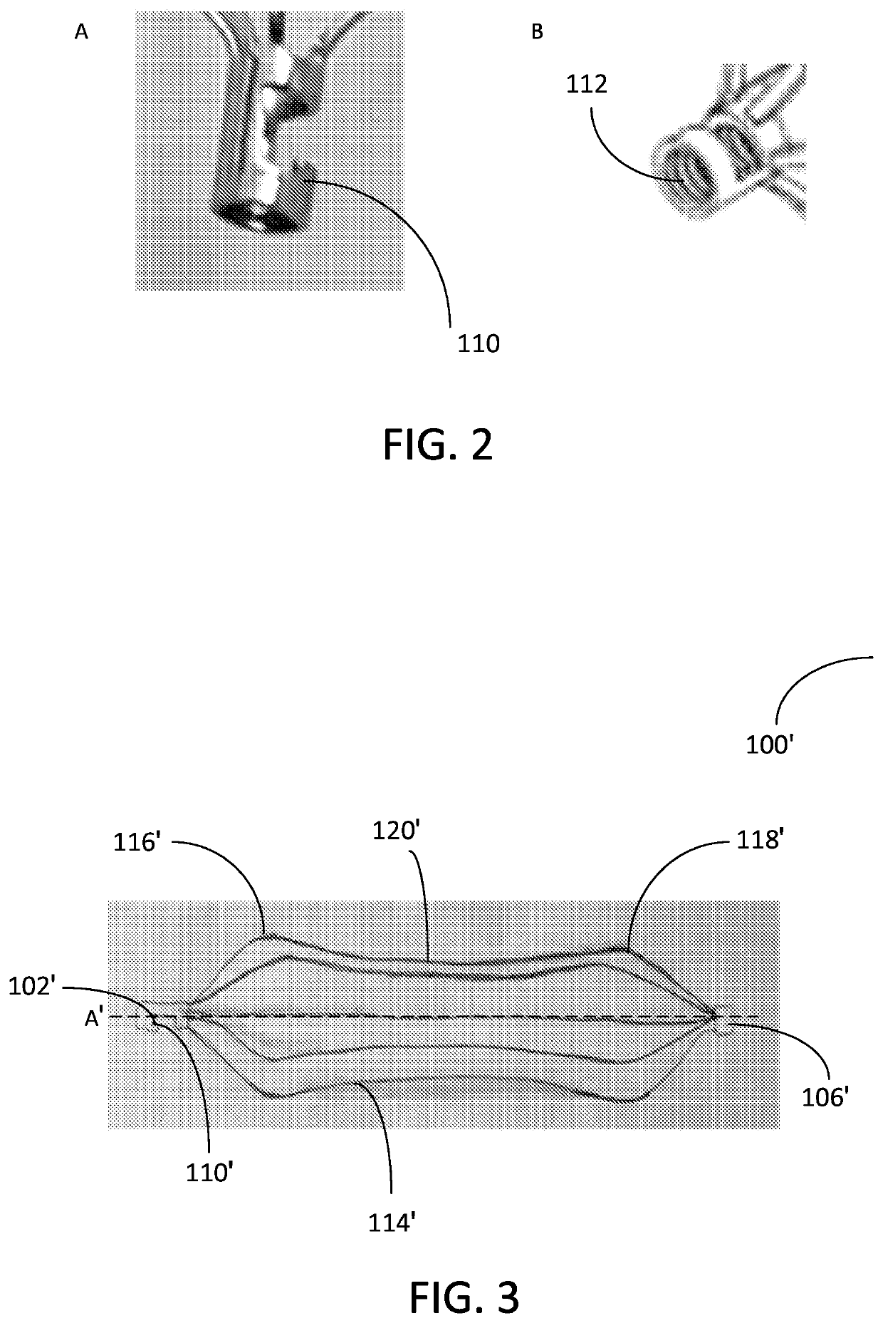 Patent ductus arteriosus stent