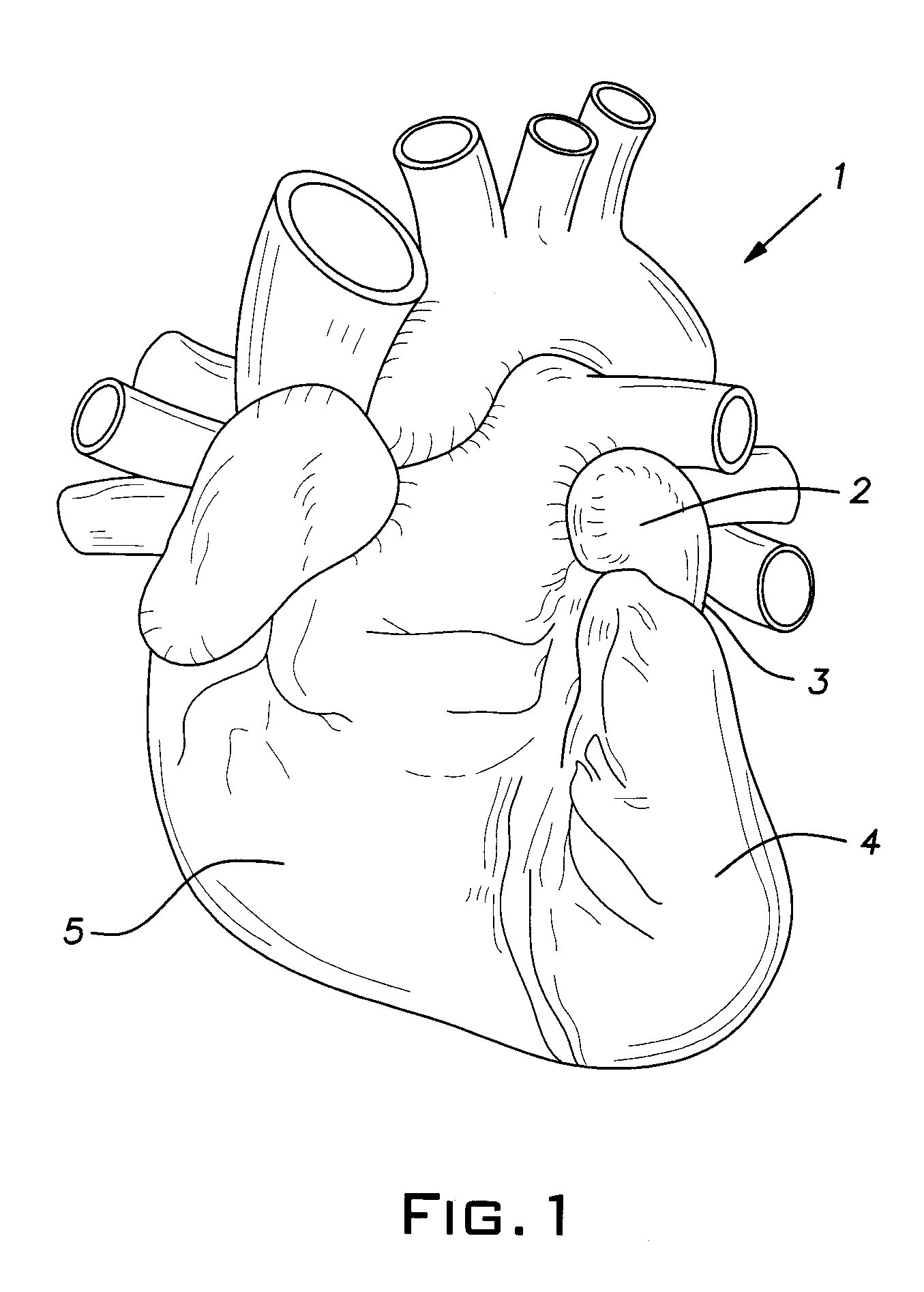 Exclusion of the left atrial appendage