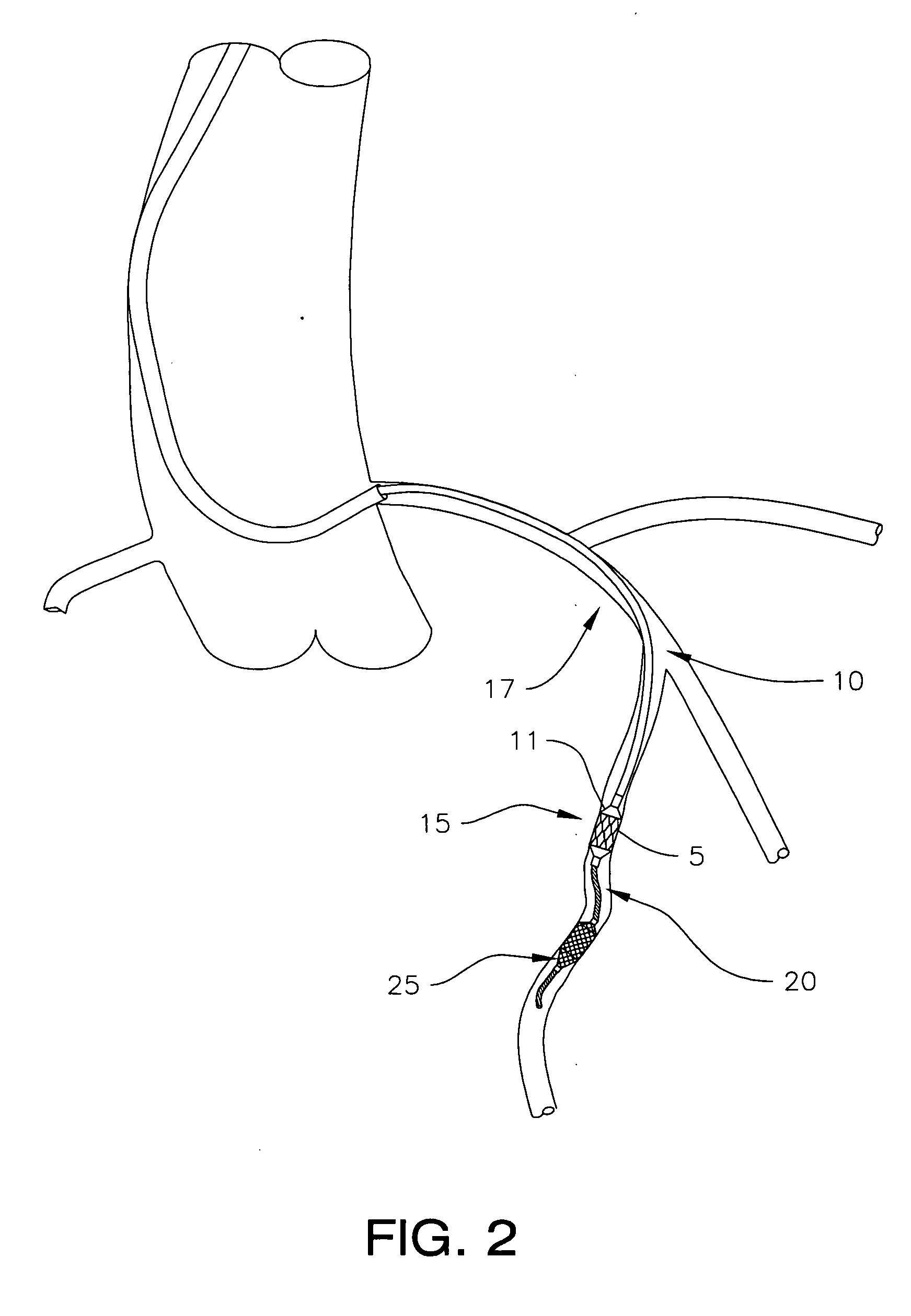 Steerable distal protection guidewire and methods of use