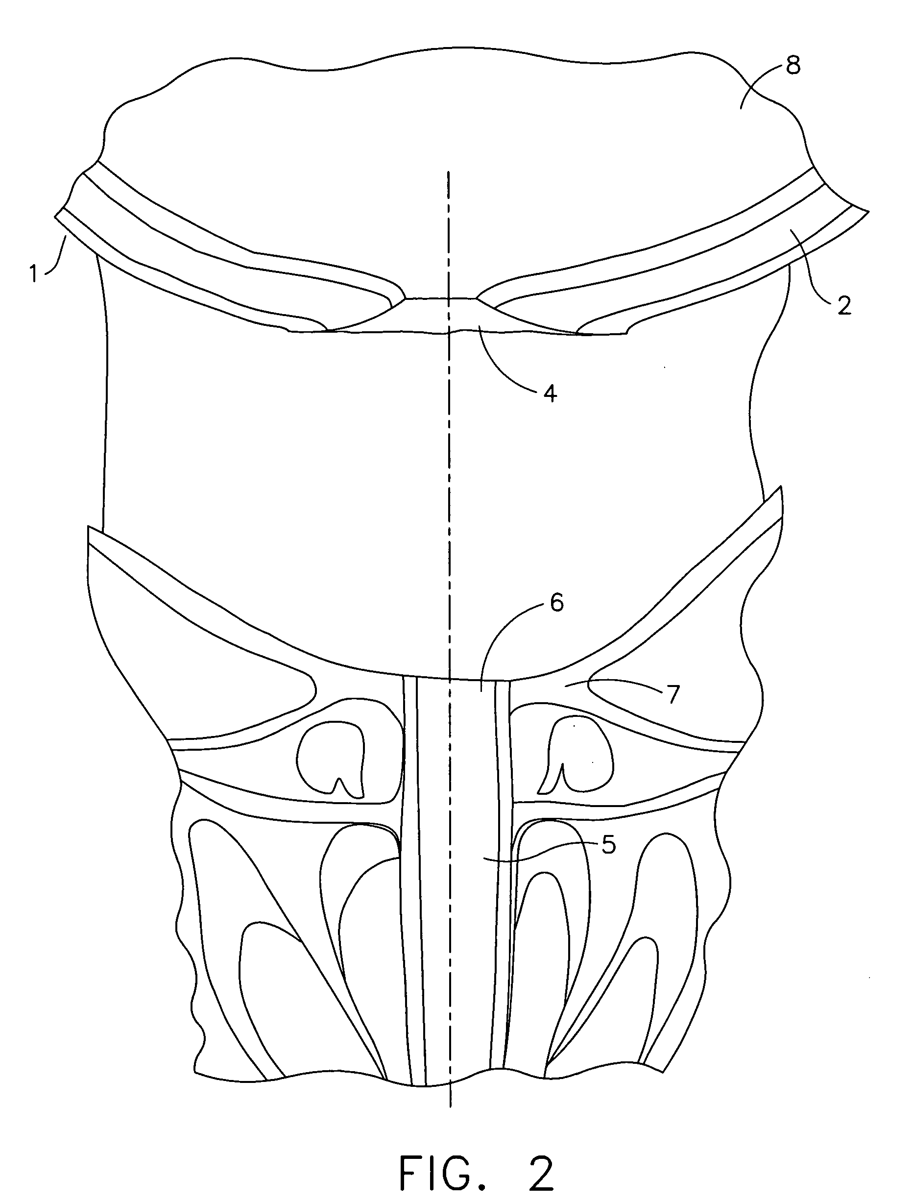 Harness and balloon catheter assembly and method for use in anastomosis procedures