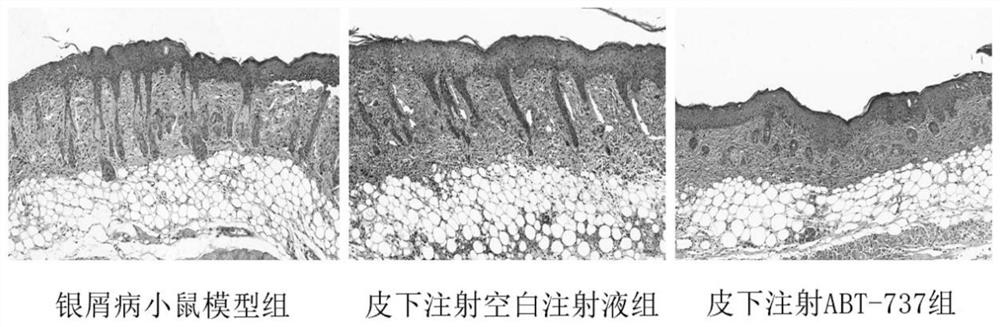 Application of BCL-2 inhibitor and pharmaceutical composition for treating senescence-related skin diseases