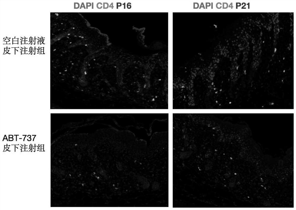 Application of BCL-2 inhibitor and pharmaceutical composition for treating senescence-related skin diseases