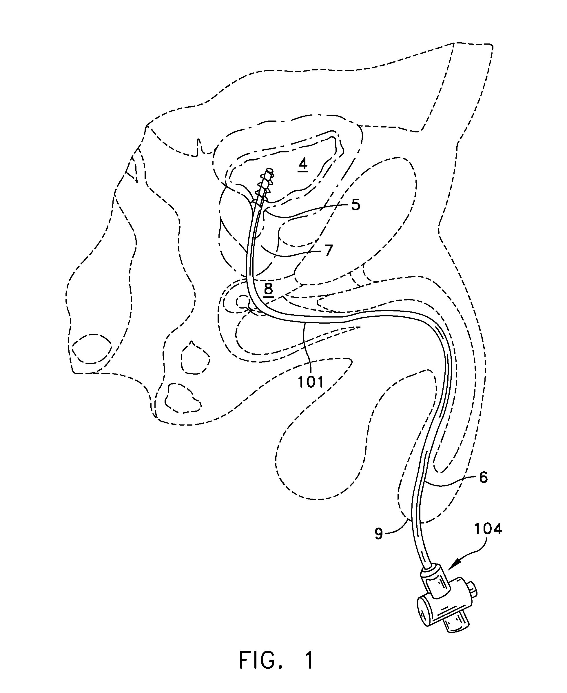 Rotate-to-advance catheterization system