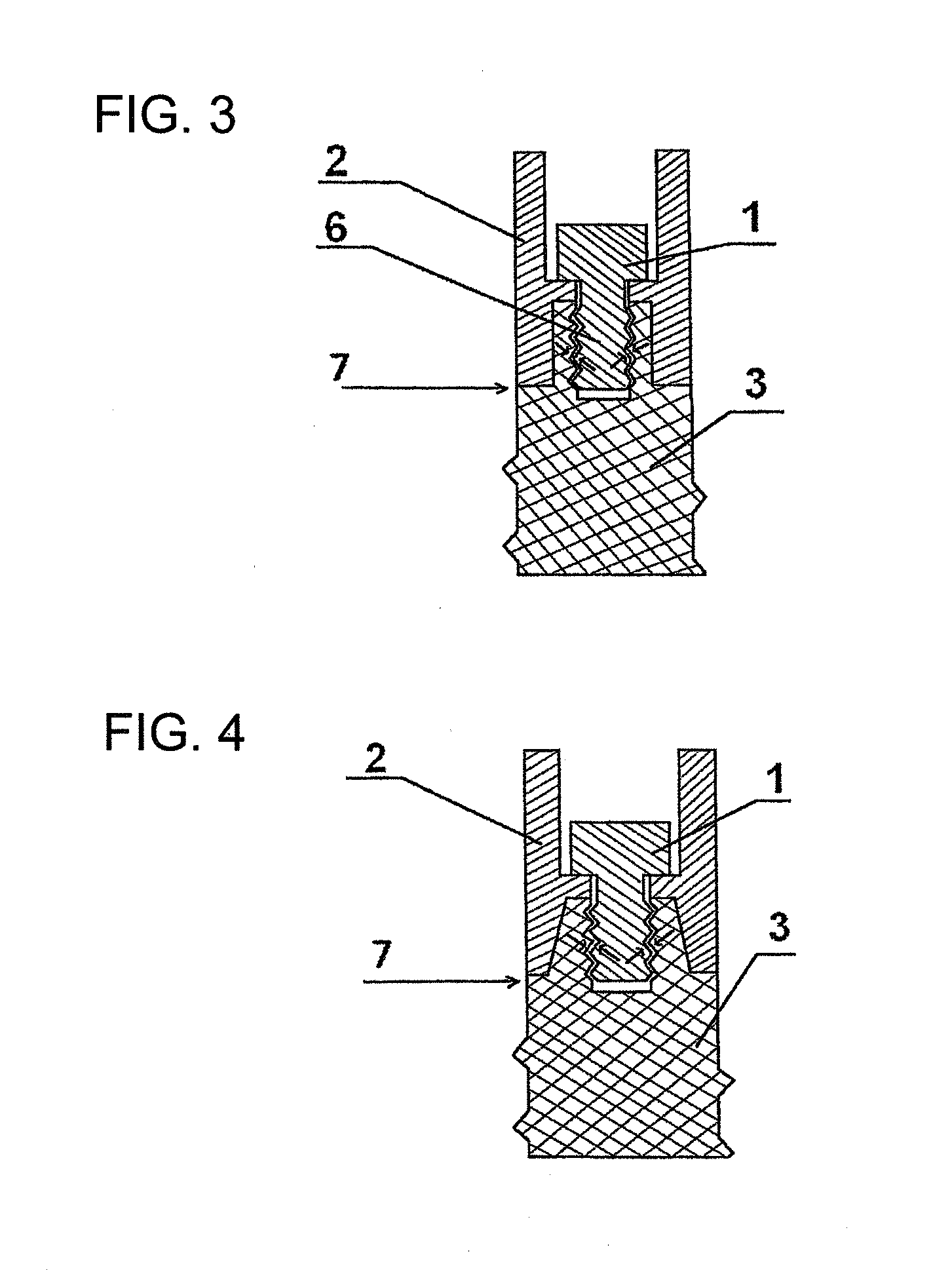 Dental prosthesis