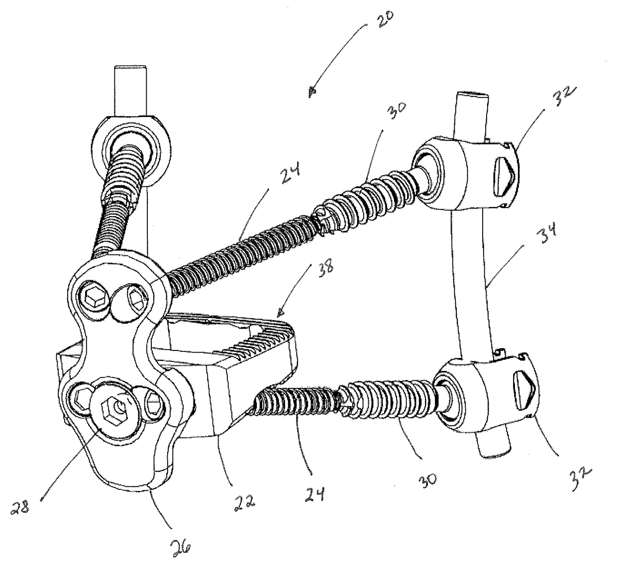 Three column spinal fixation implants and associated surgical methods