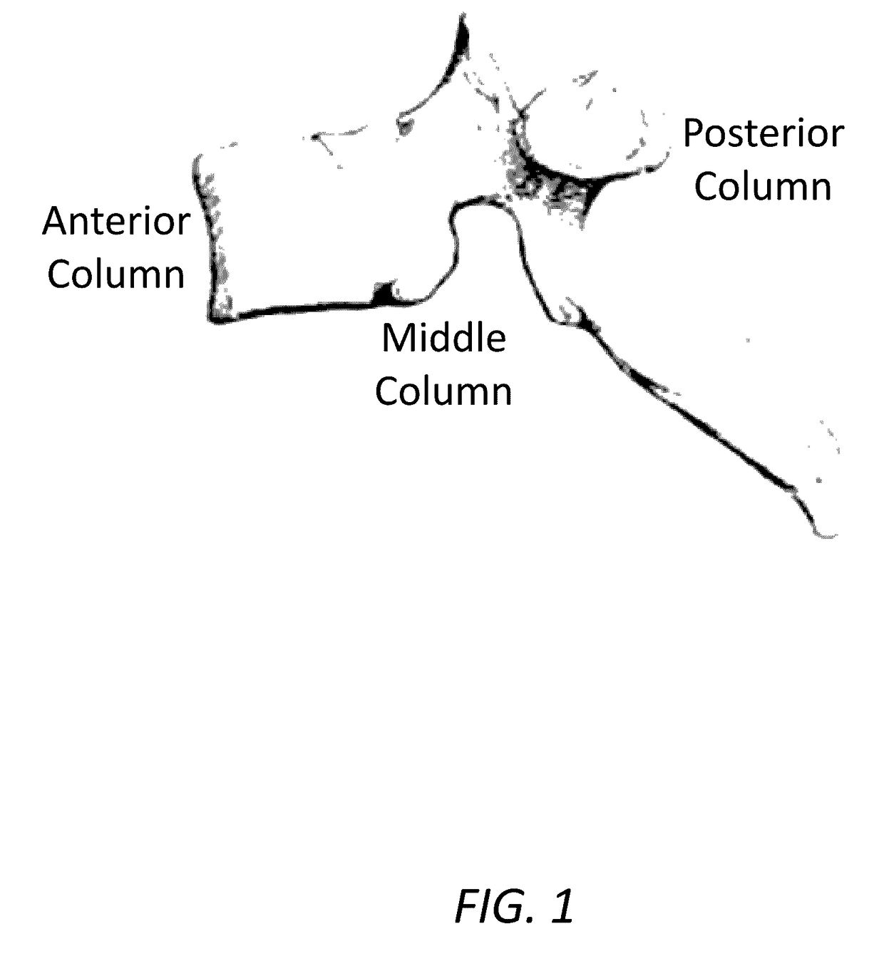 Three column spinal fixation implants and associated surgical methods