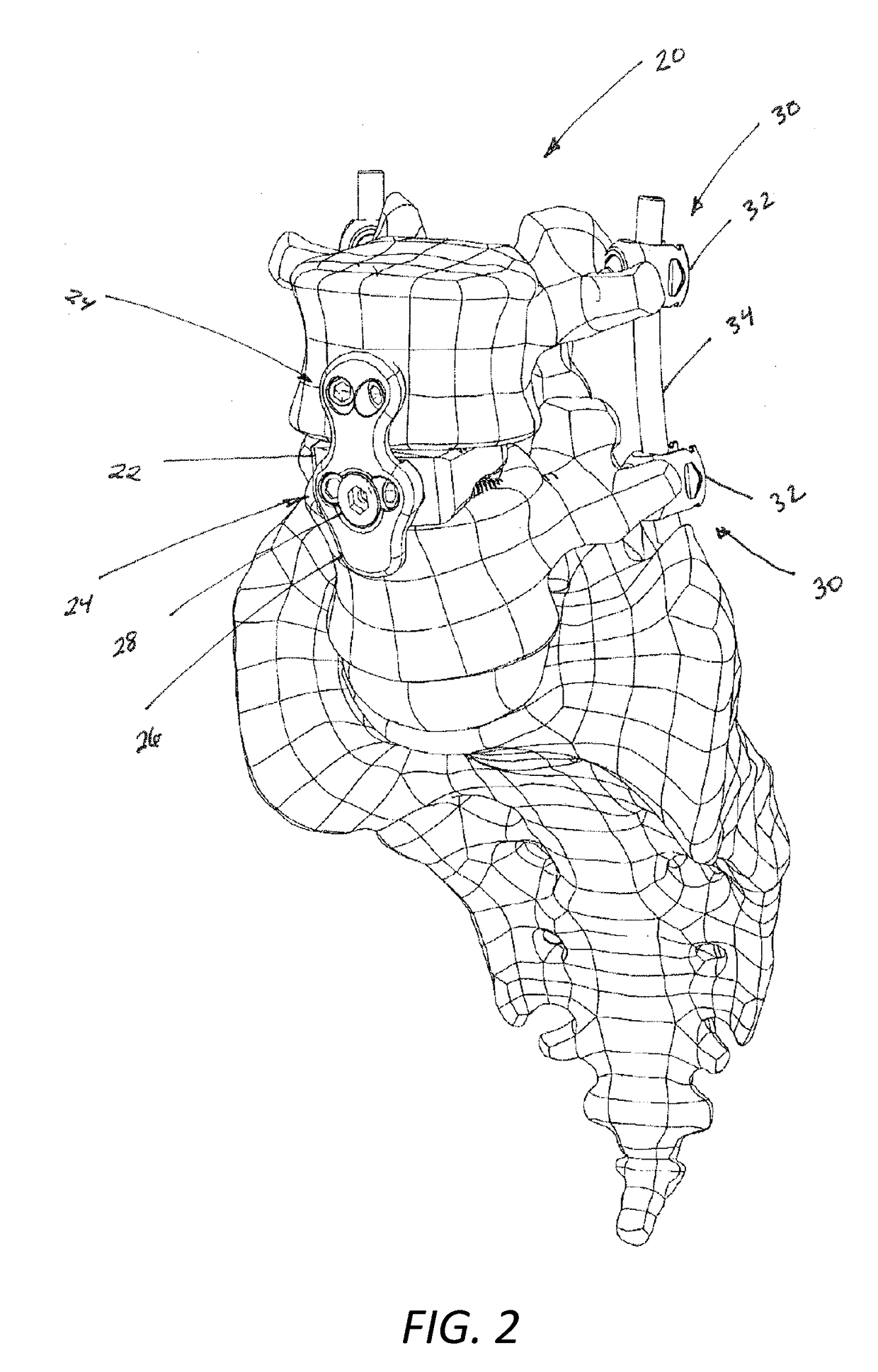 Three column spinal fixation implants and associated surgical methods