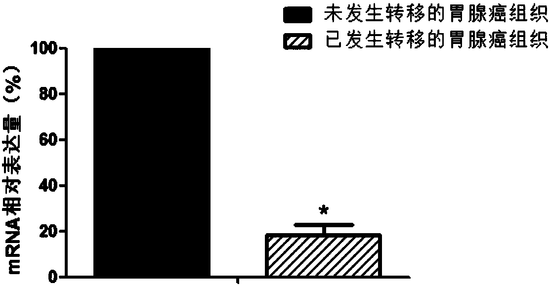 Application of using PLCD4 gene as gastric adenocarcinoma transfer diagnosis marker