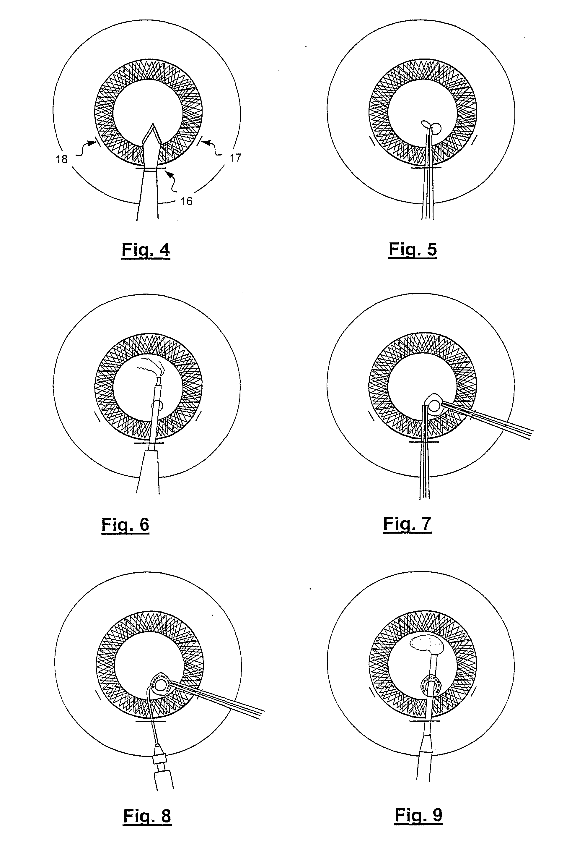 Optical fiber laser device for ocular suturing