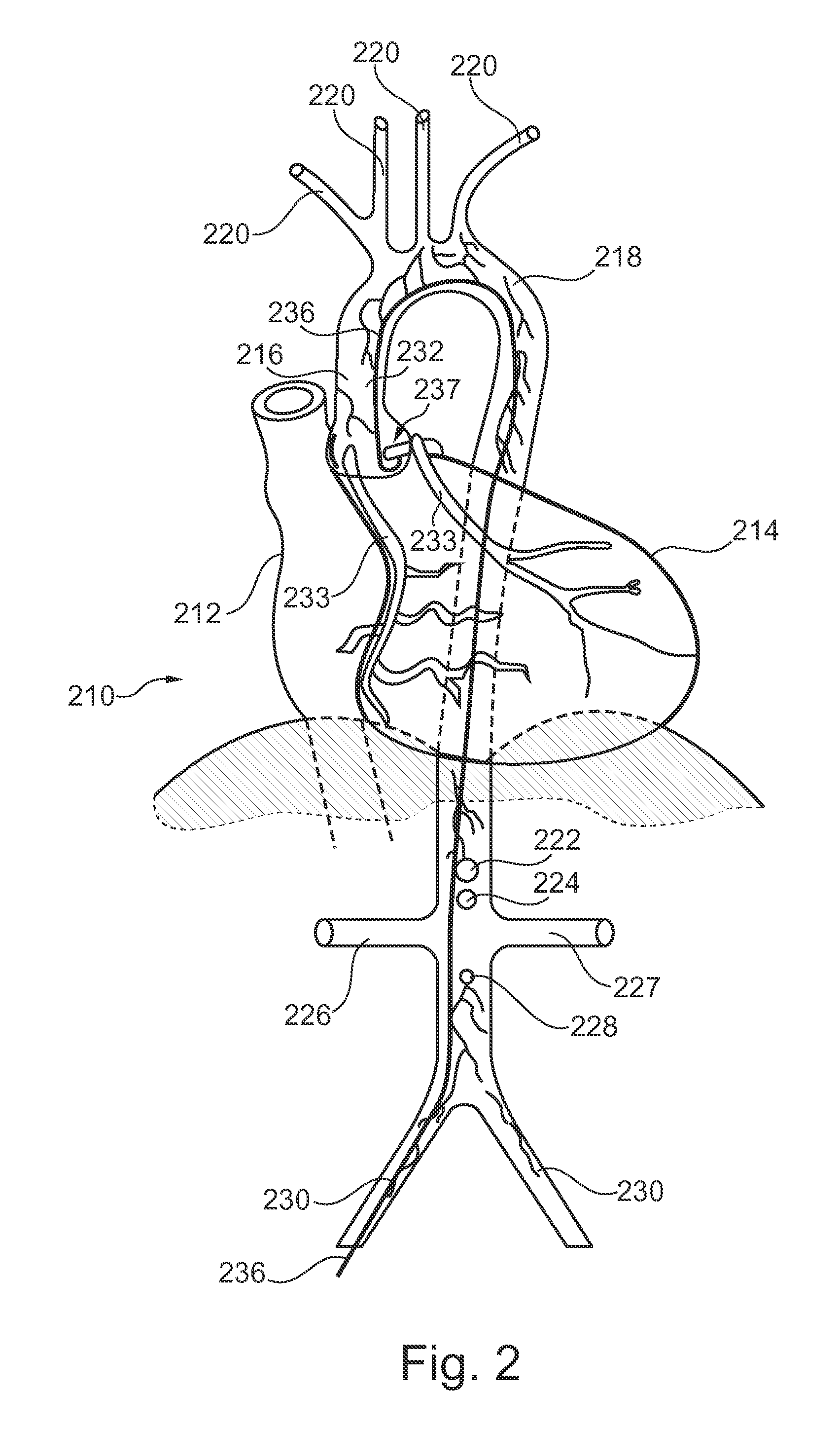 Medical imaging device for providing an image representation supporting the accurate positioning of an invention device in vessel intervention procedures