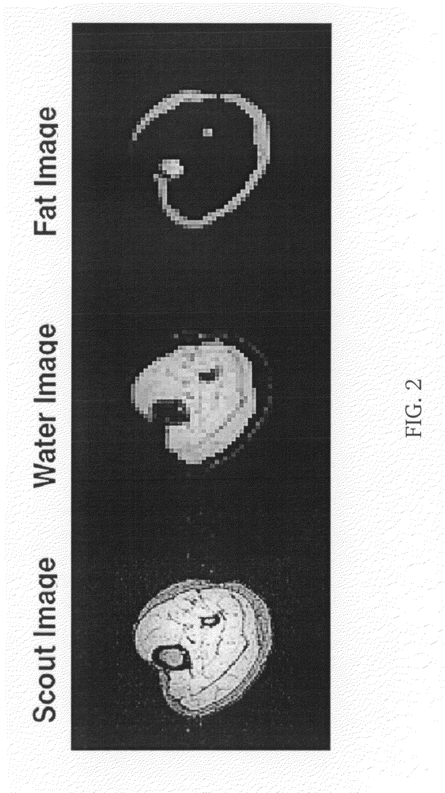 Non iterative shimming in magnetic resonance imaging in the presence of high LIPID levels