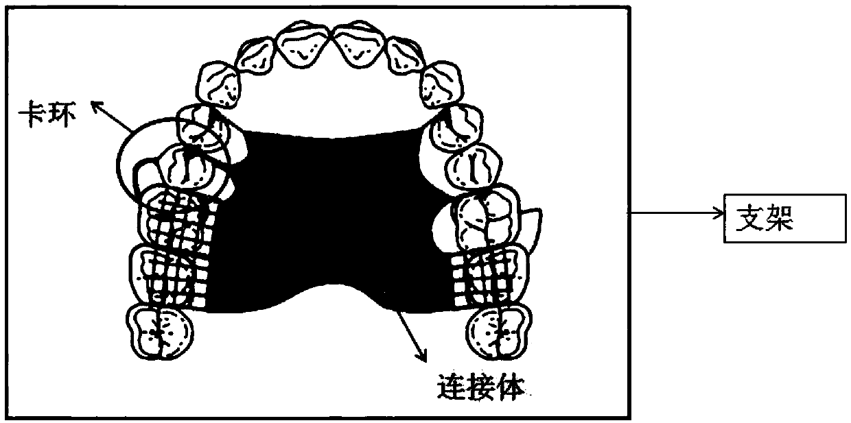 Intelligent recommendation based virtual movable denture design method and system