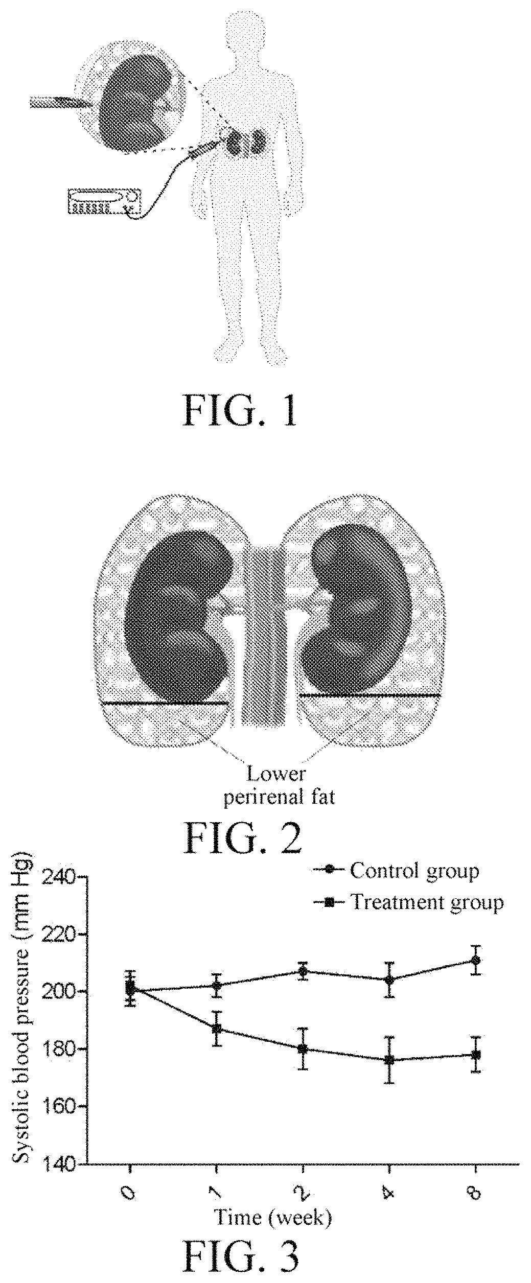 Application of radiofrequency catheter ablation system to treatment of essential hypertension