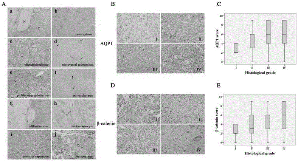 Positive relationship of AQP1 expression and beta-catenin expression