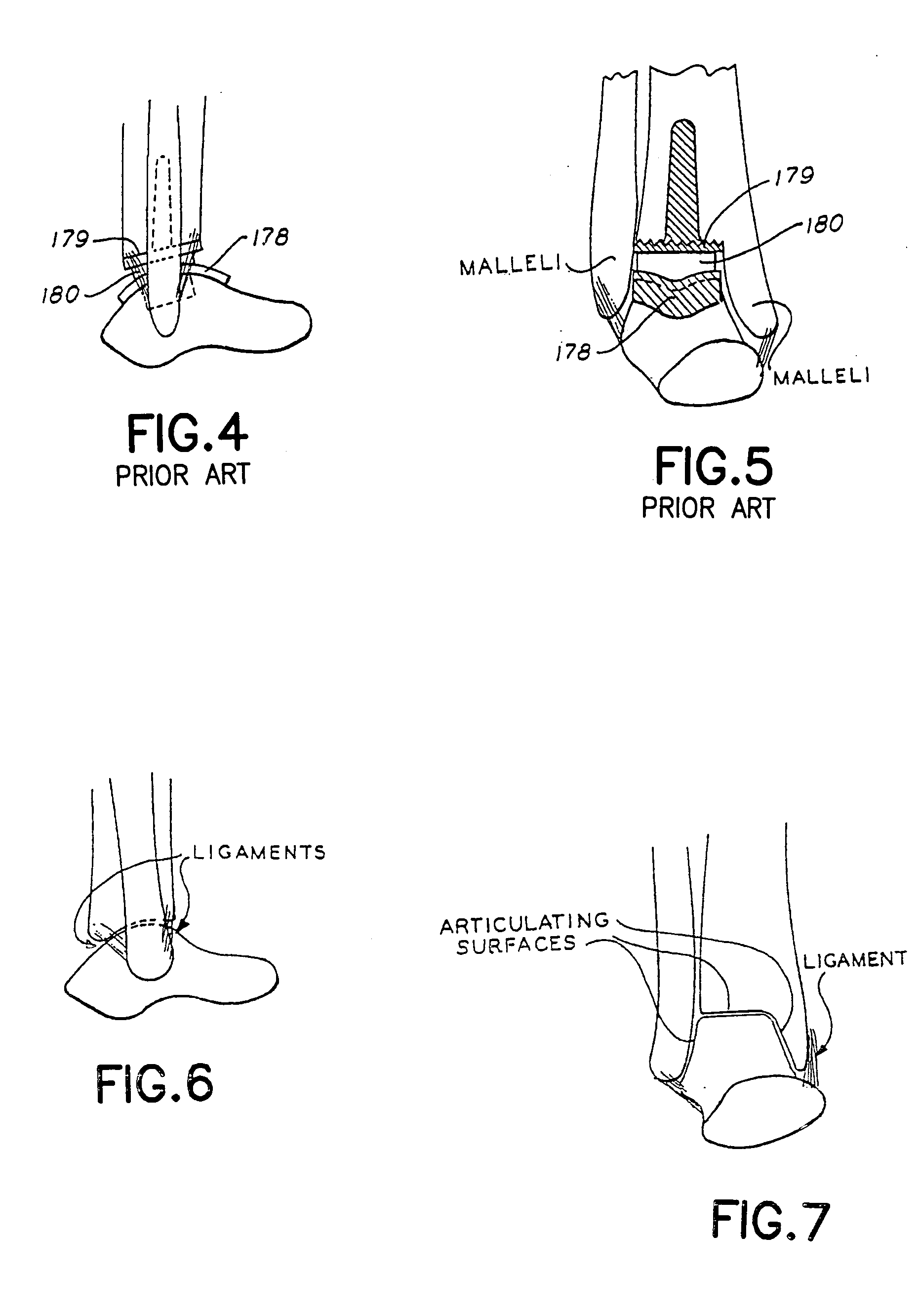 Ankle prosthesis including tibial component having peripheral wall for preventing the formation of bone cysts